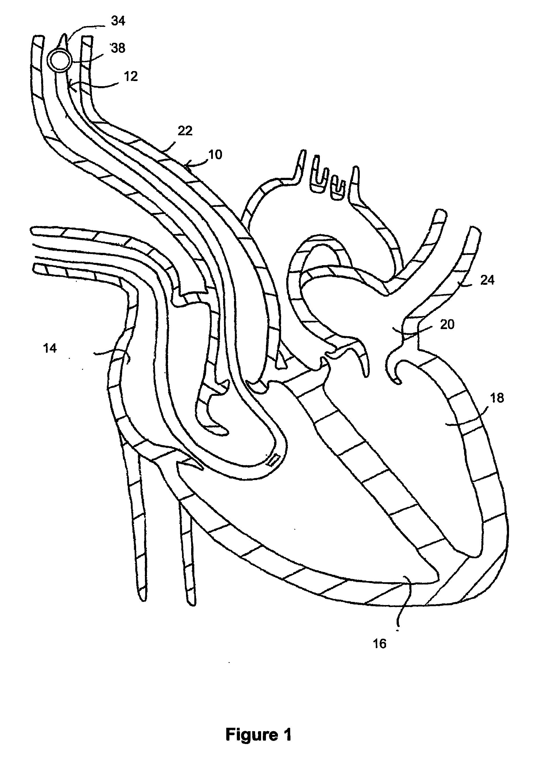 Catherter for measuring an intraventricular pressure and method of using same