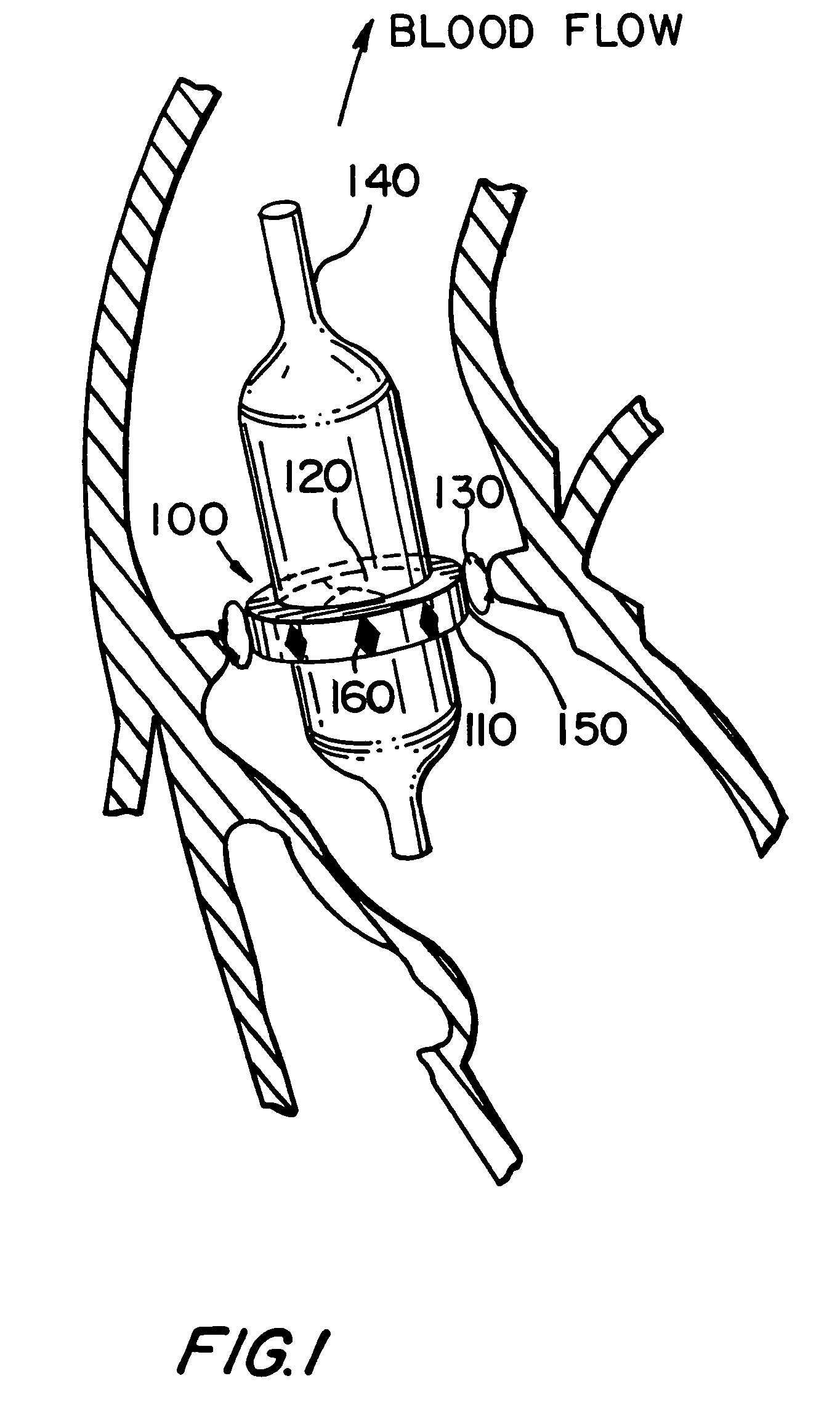 Artificial heart valve attachment apparatus and methods