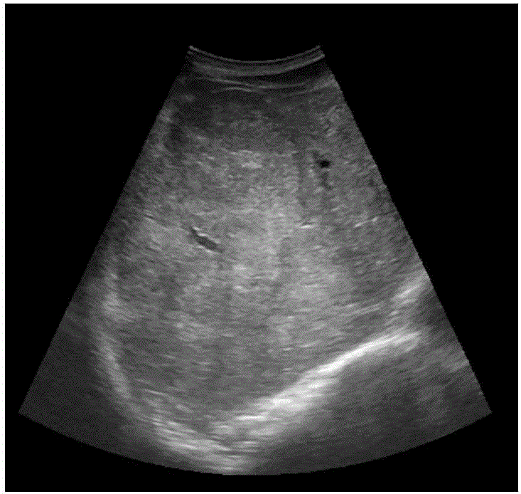 Method for extracting liver region in ultrasound image