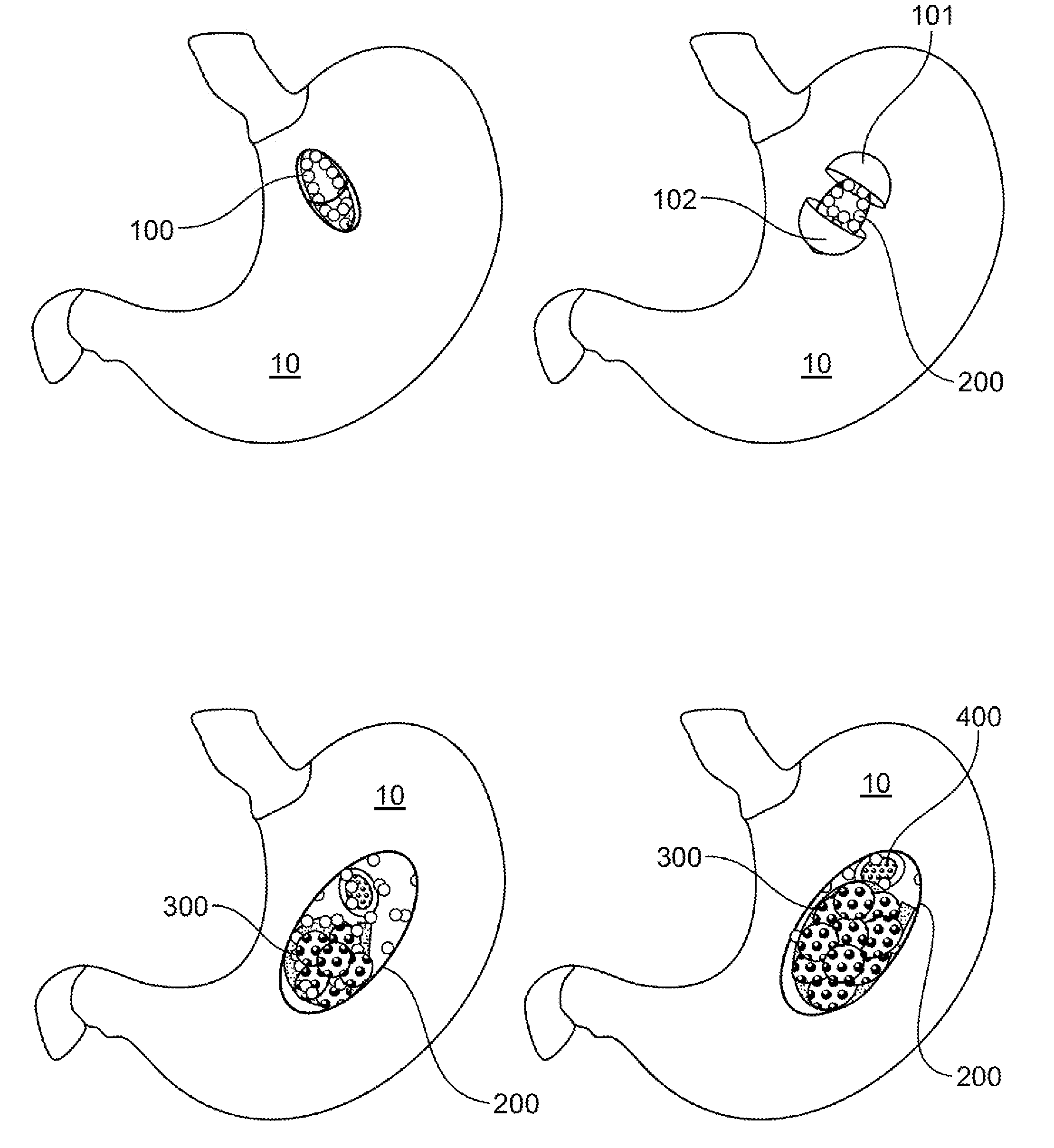 Device and method for reducing calorie intake