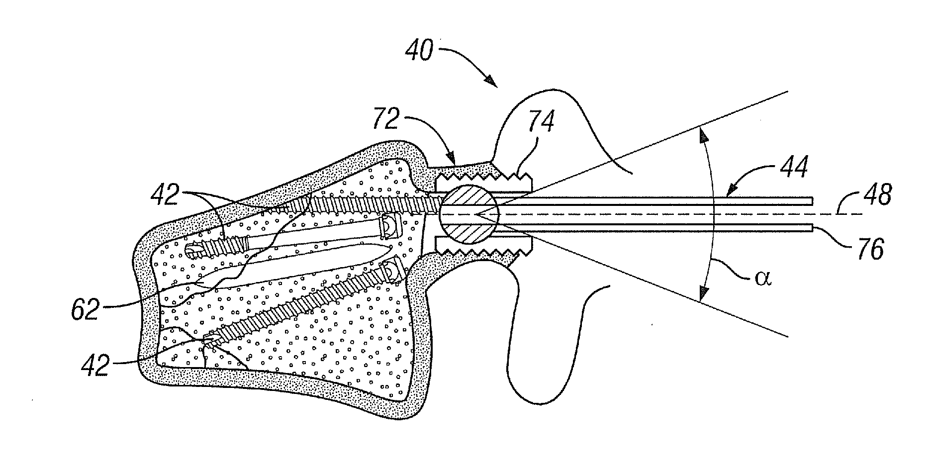 Devices and Methods for Treating Vertebral Fractures