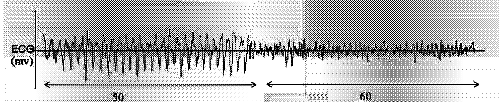 Method and apparatus for analyzing cardiac rhythm during CPR