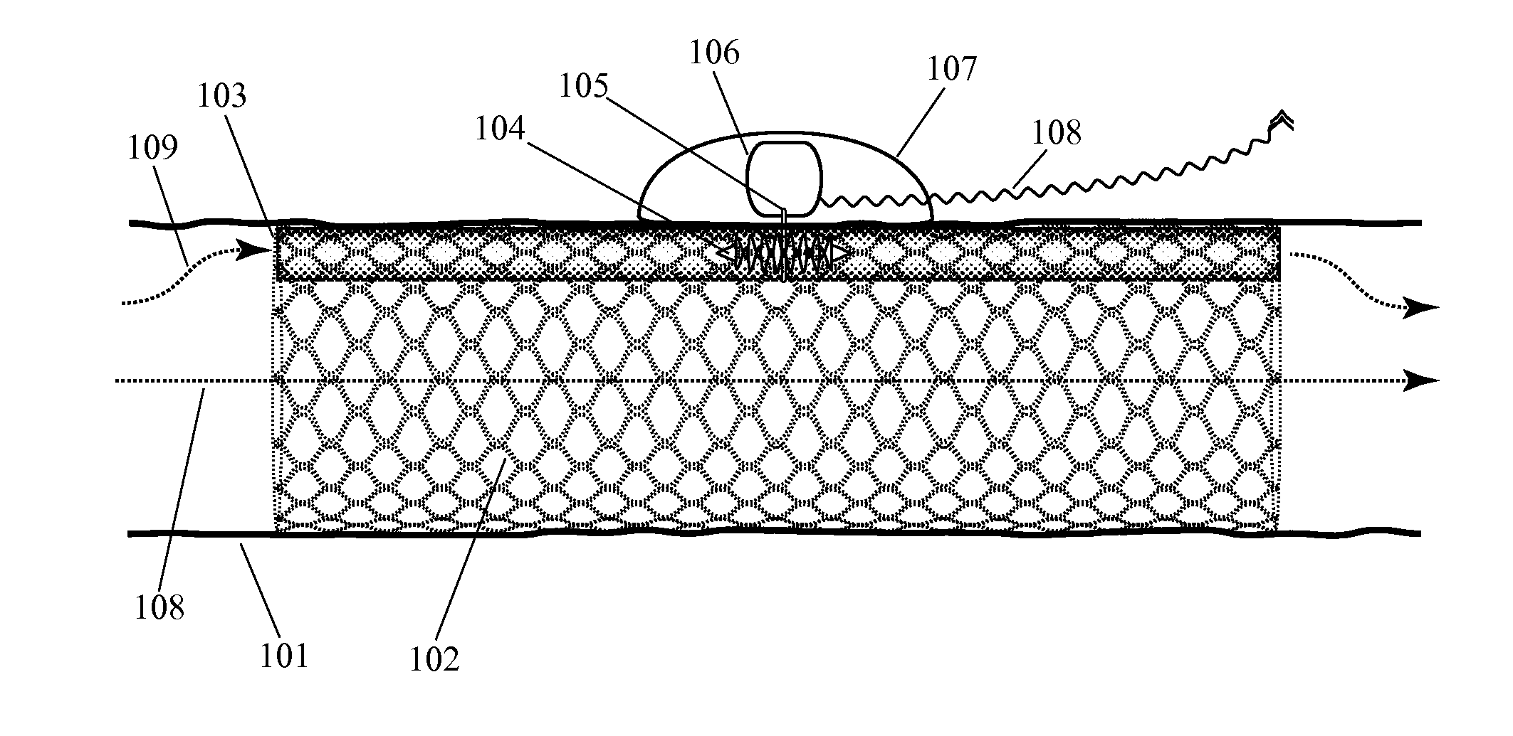 Implanted Extracardiac Device for Circulatory Assistance