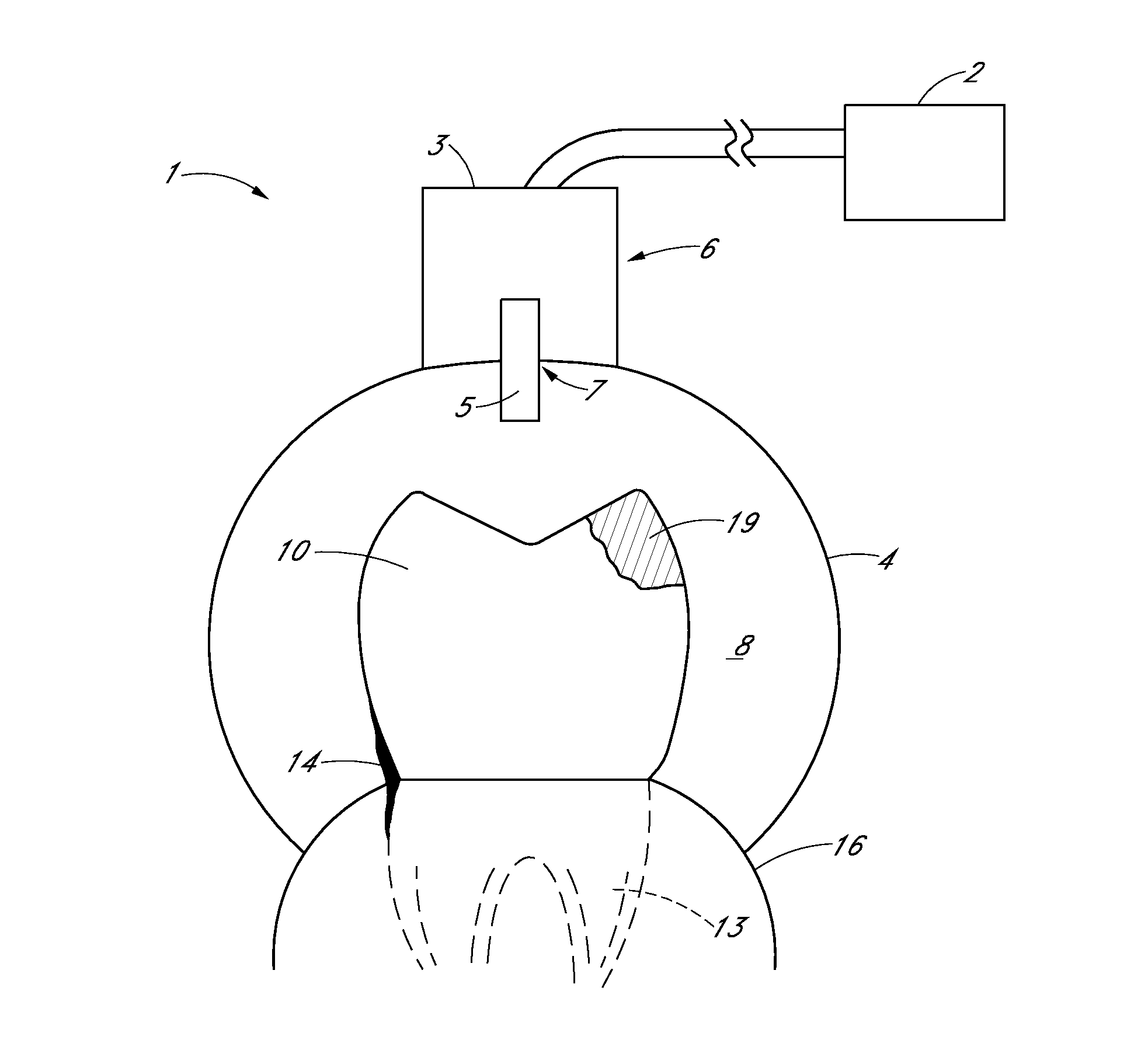 Apparatus and methods for treating teeth