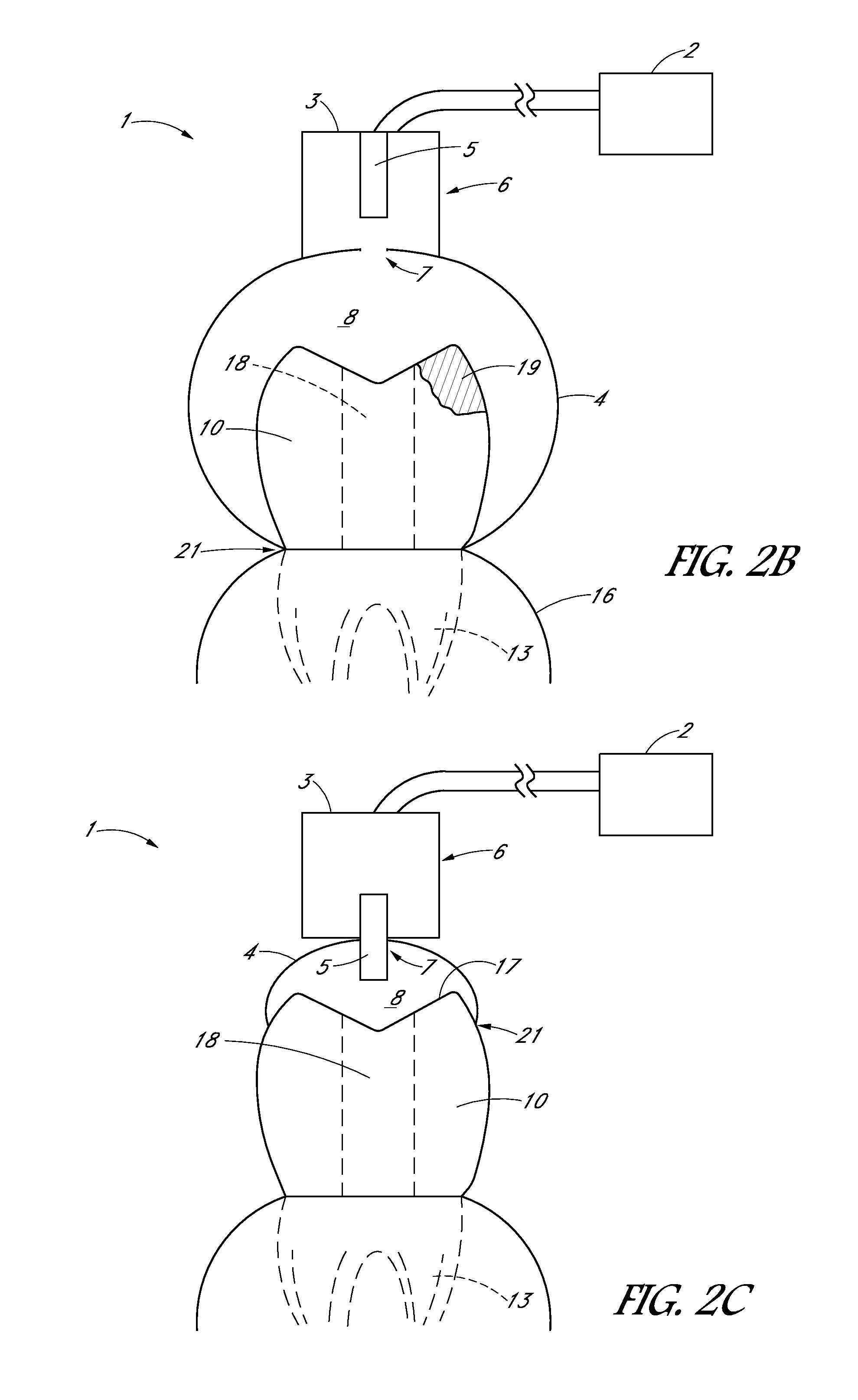 Apparatus and methods for treating teeth