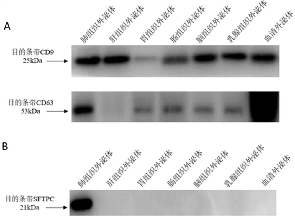 Application of protein SFTPC as lung cancer diagnostic marker and kit
