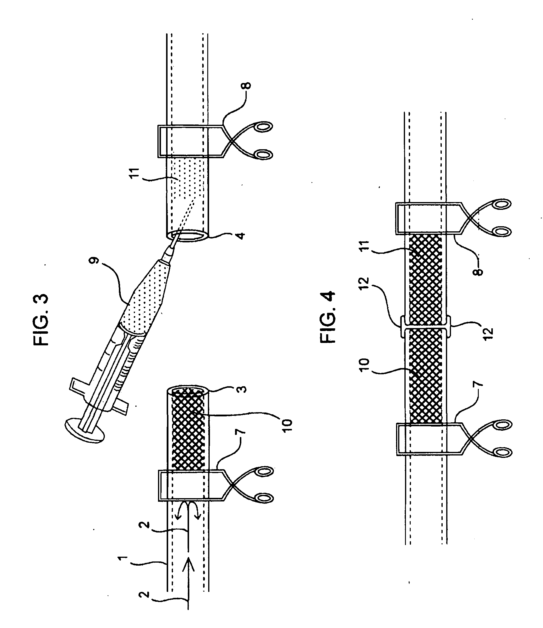 Compositions and methods for joining non-conjoined lumens