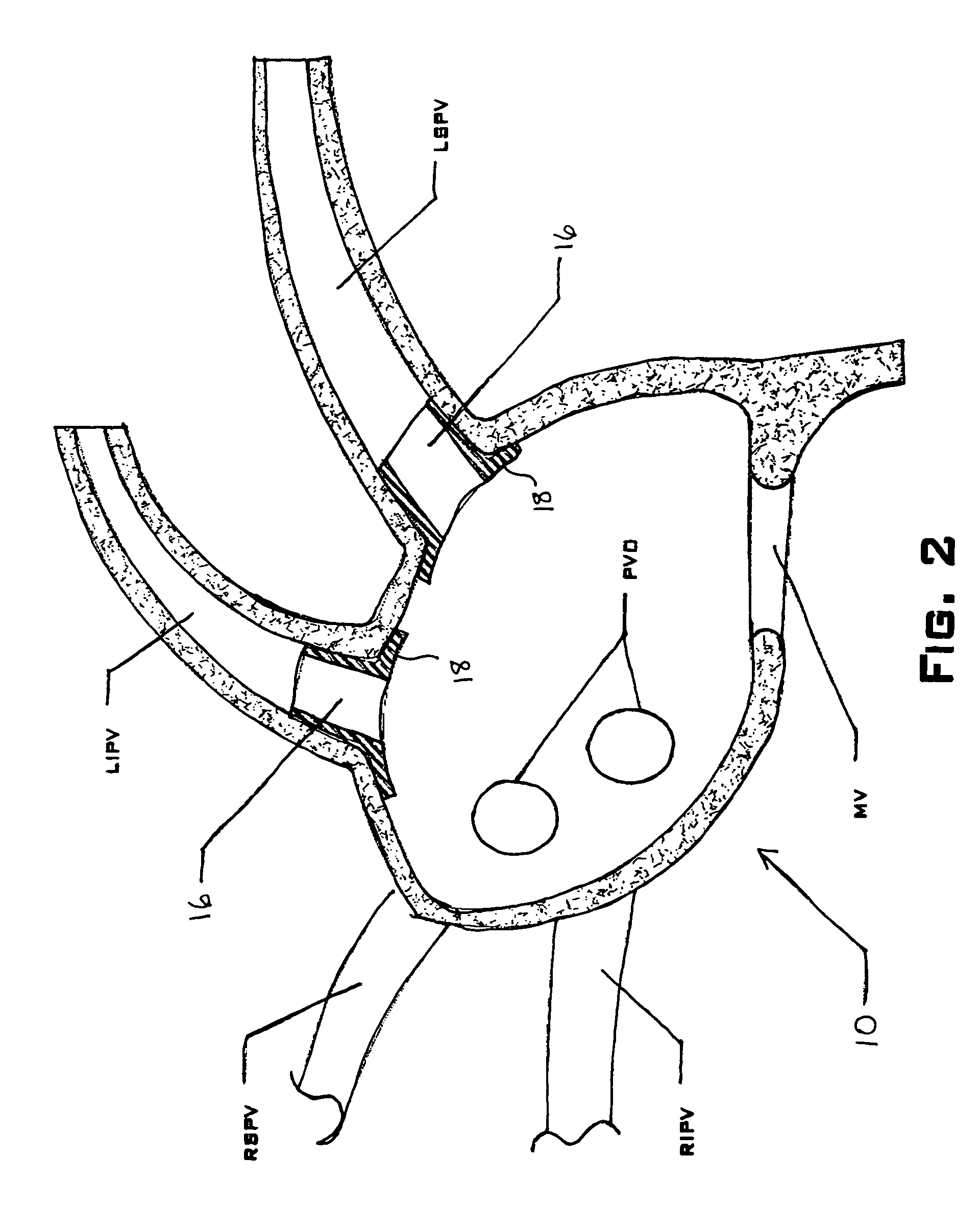Device and method for electrical isolation of the pulmonary veins