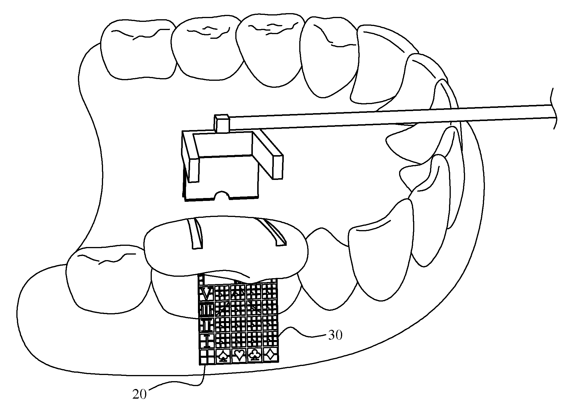 Multi-coordinate orthodontic implant positioning device