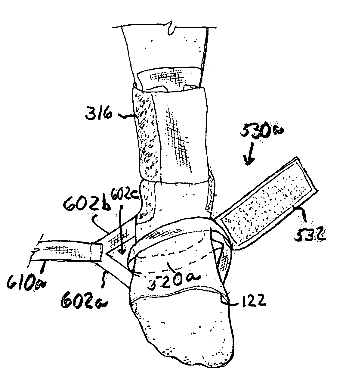 Counterforce brace