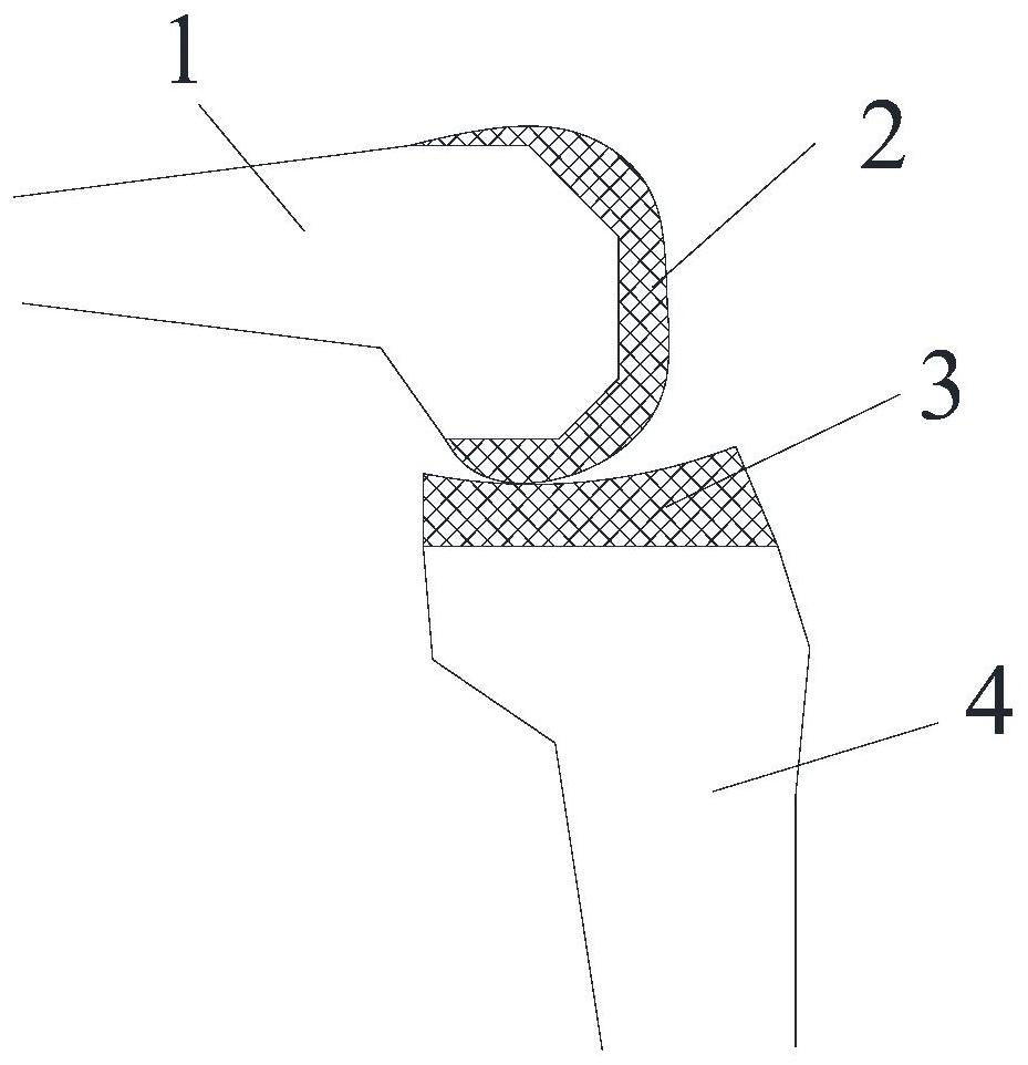 Knee joint bone surface replacement device