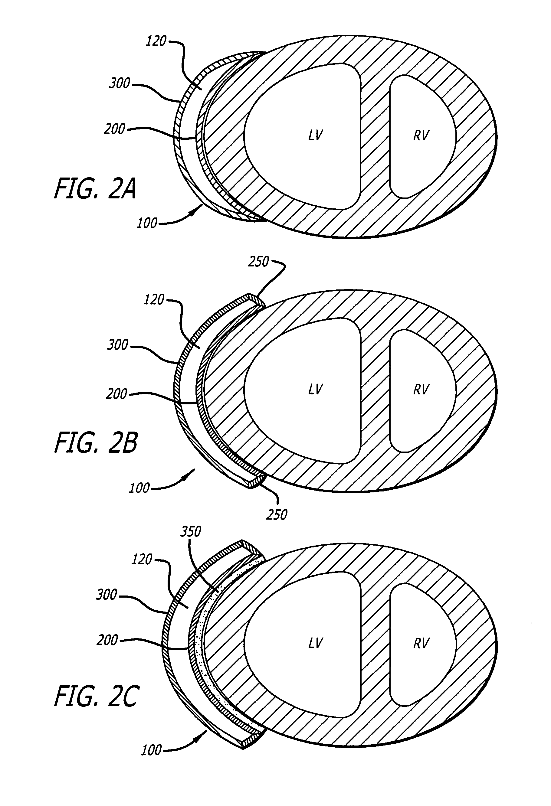 Inflatable cardiac device for treating and preventing ventricular remodeling