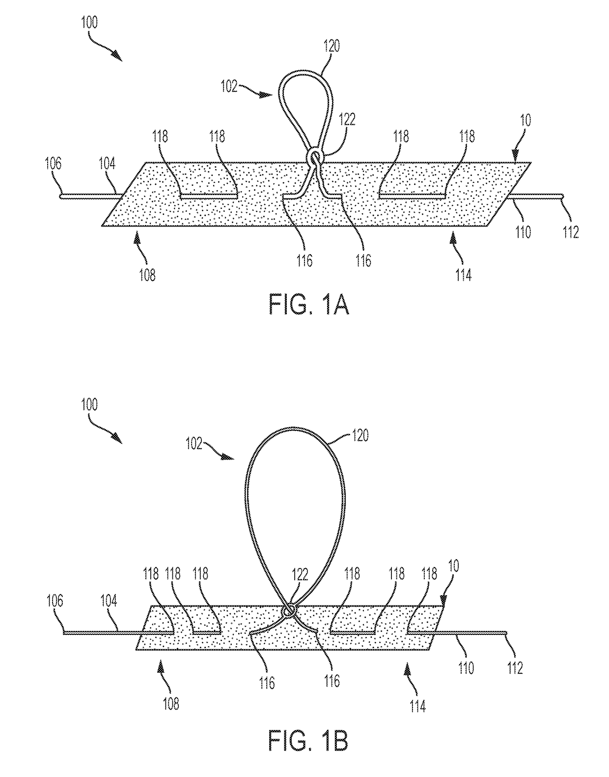 Anchored Loop-in-Loop Suture Anchor