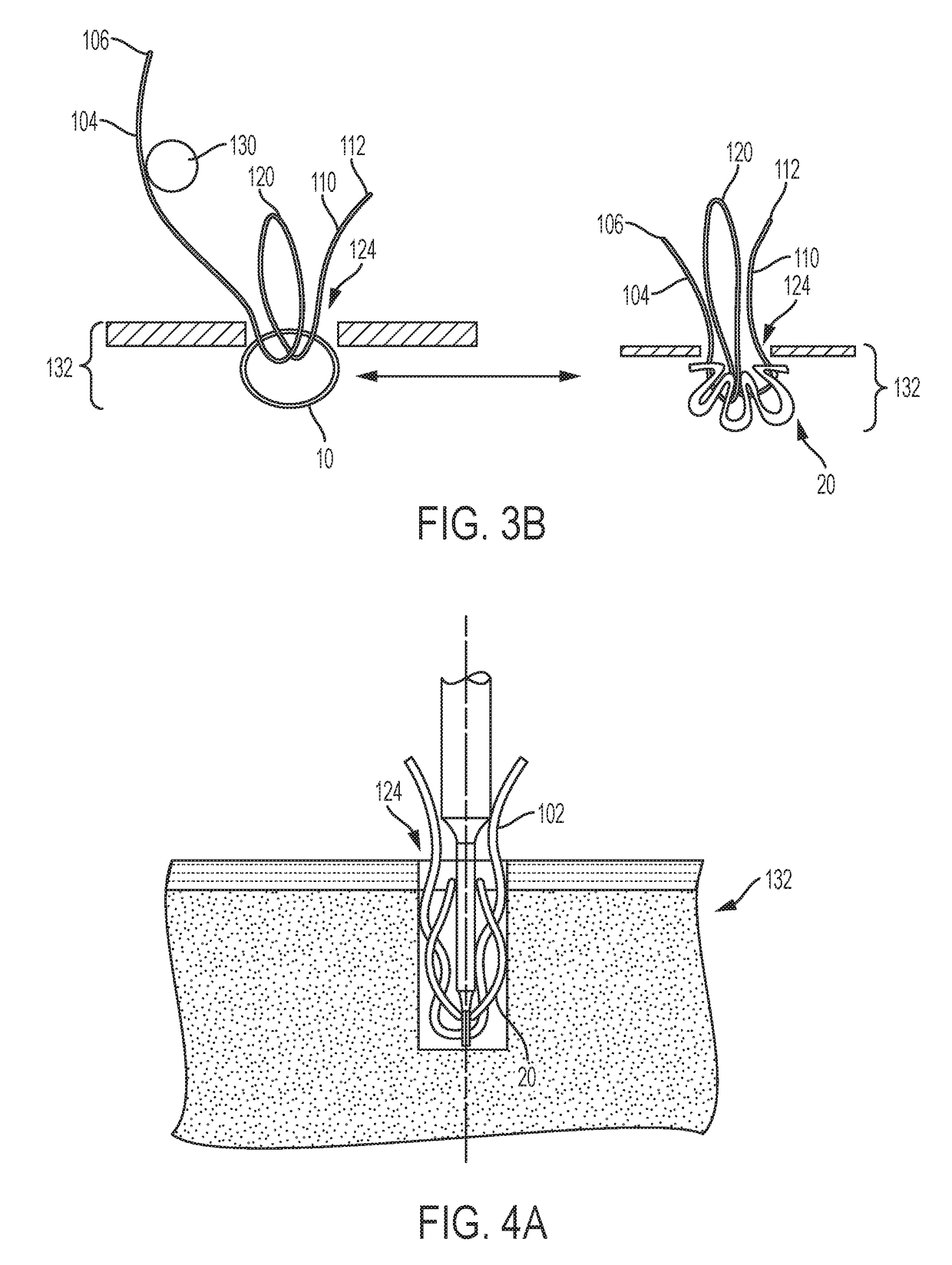 Anchored Loop-in-Loop Suture Anchor