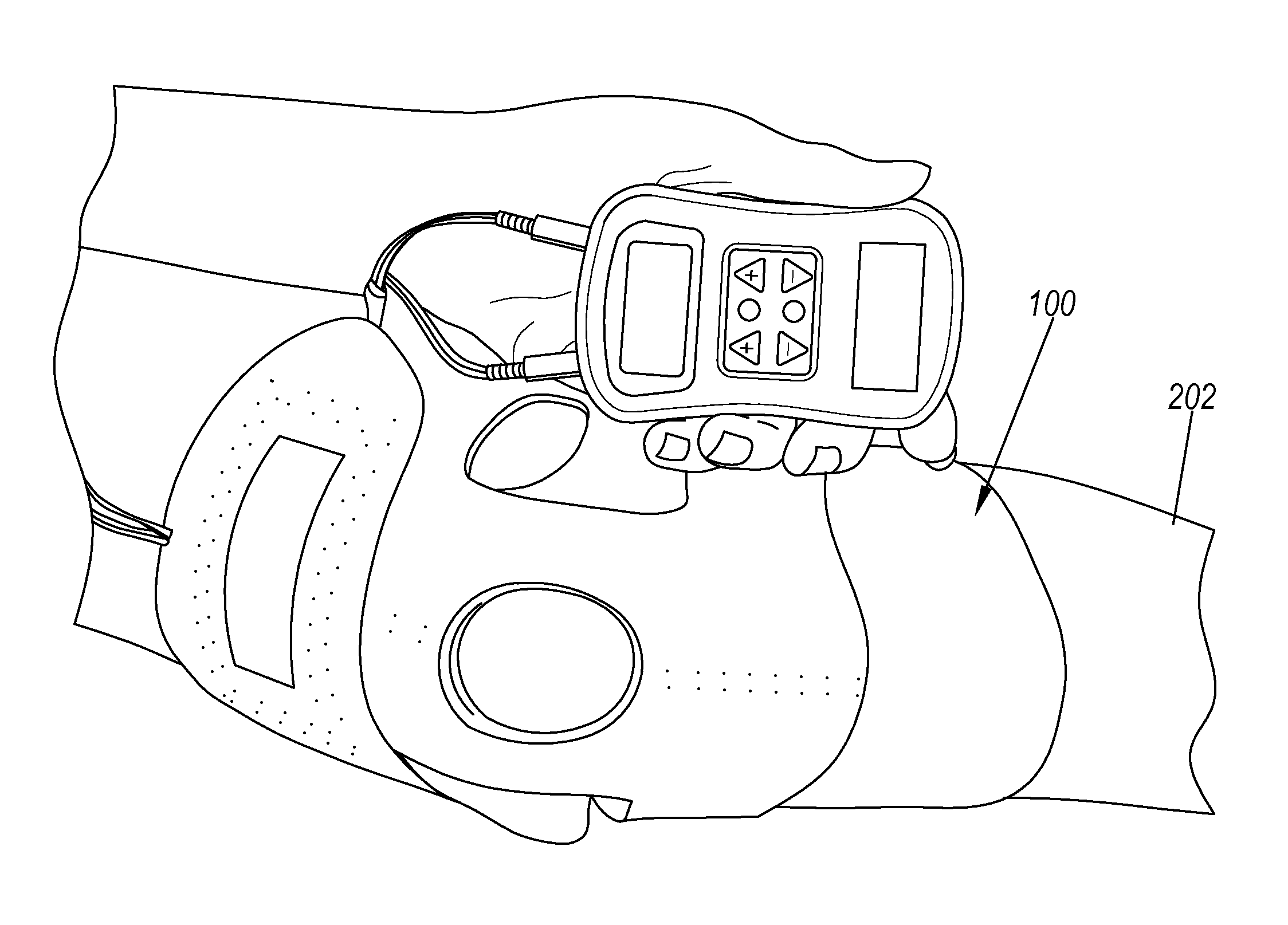 Transcutaneous electrical nerve stimulation of the knee