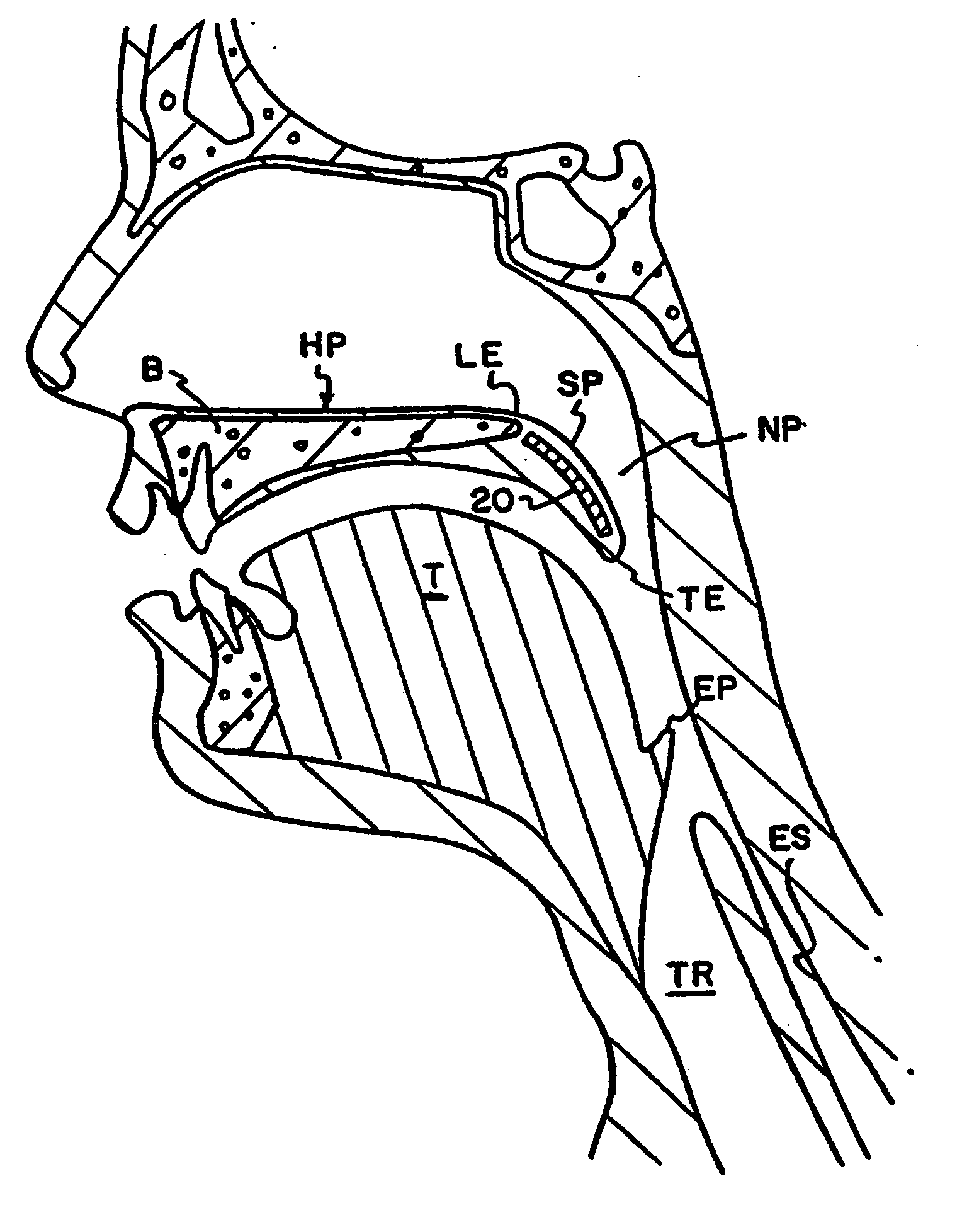 Resorbable airway implant