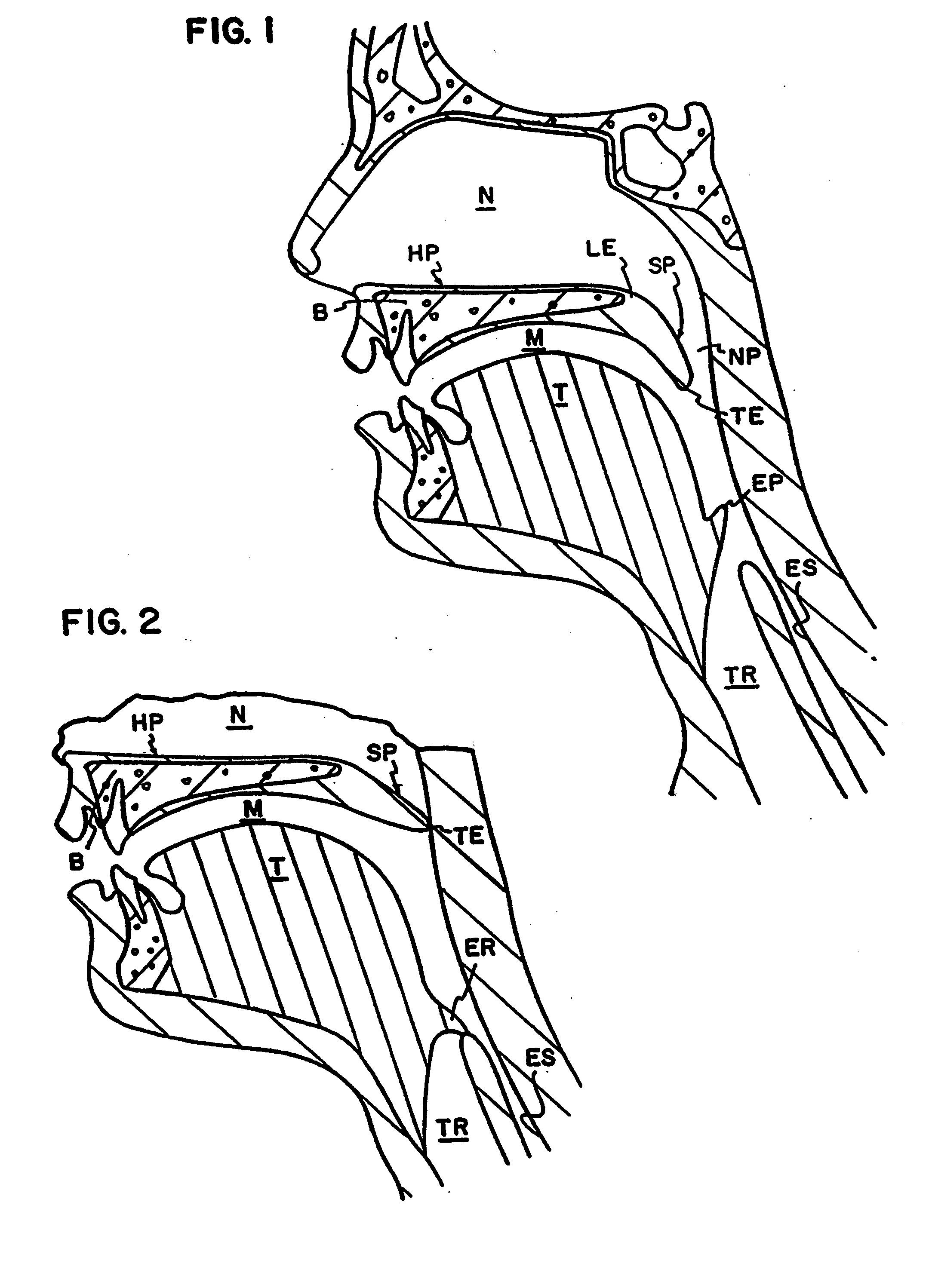 Resorbable airway implant