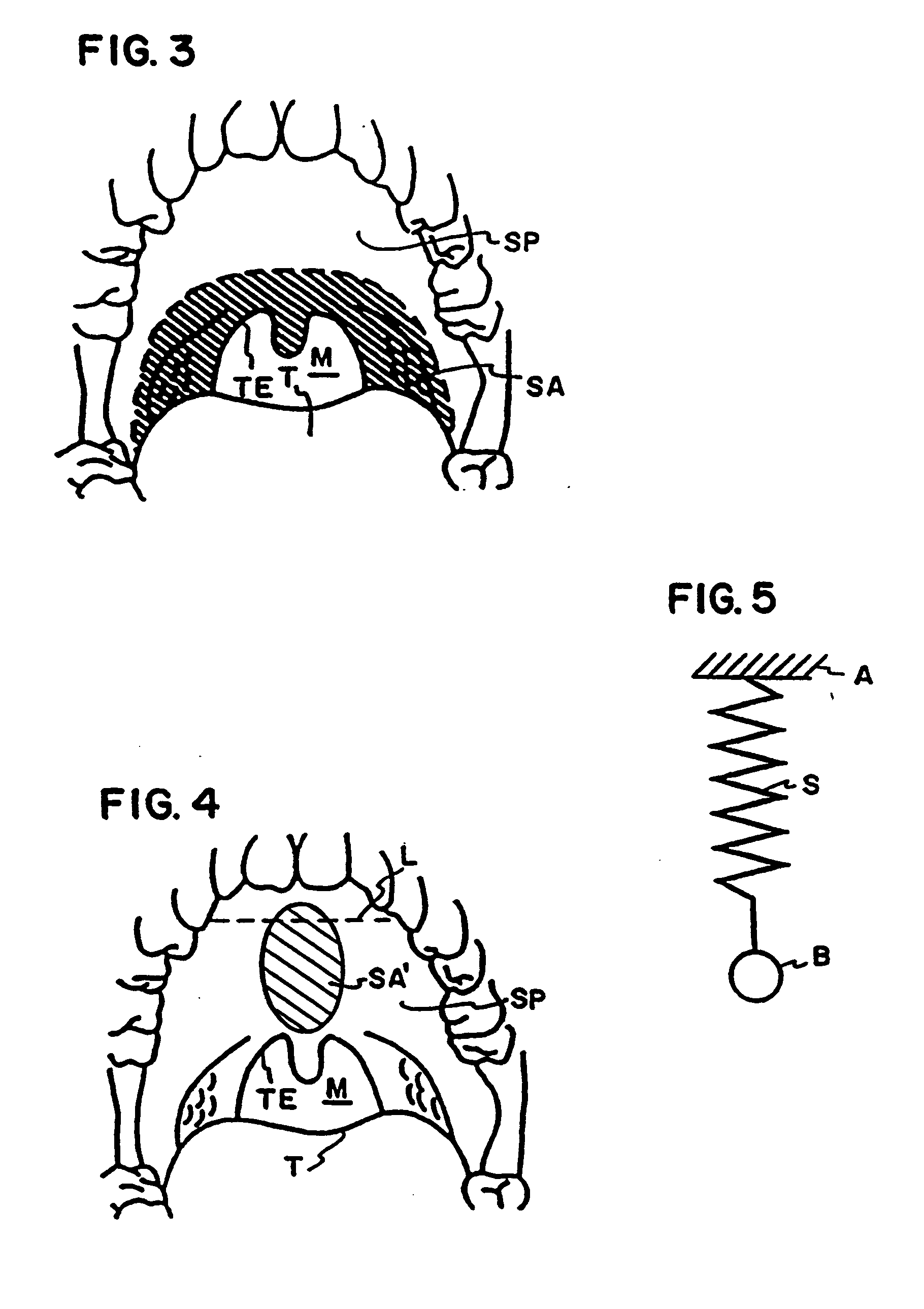 Resorbable airway implant