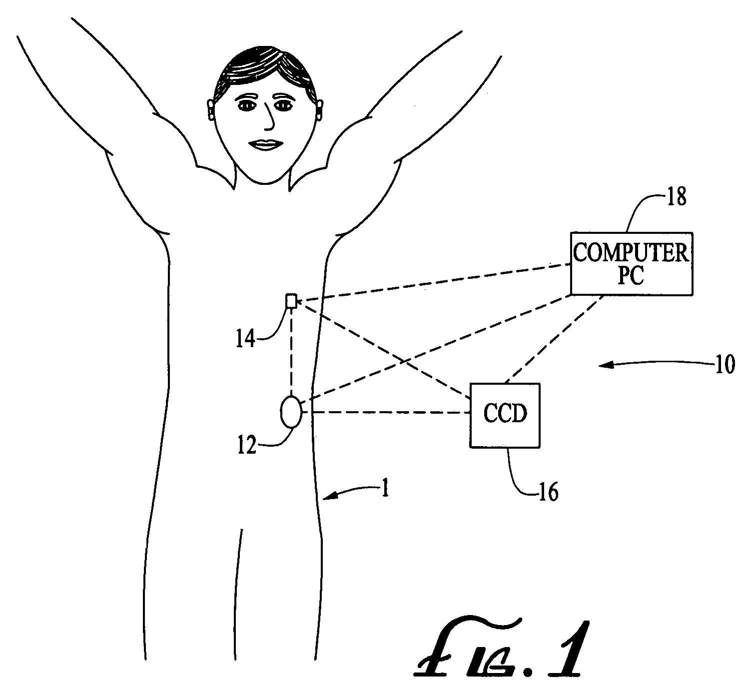 Infusion medium delivery system, device and method with needle inserter and needle inserter device and method