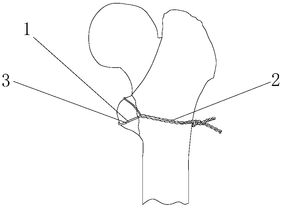 Fixing and binding band for femoral lesser trochanter bone fracture reduction