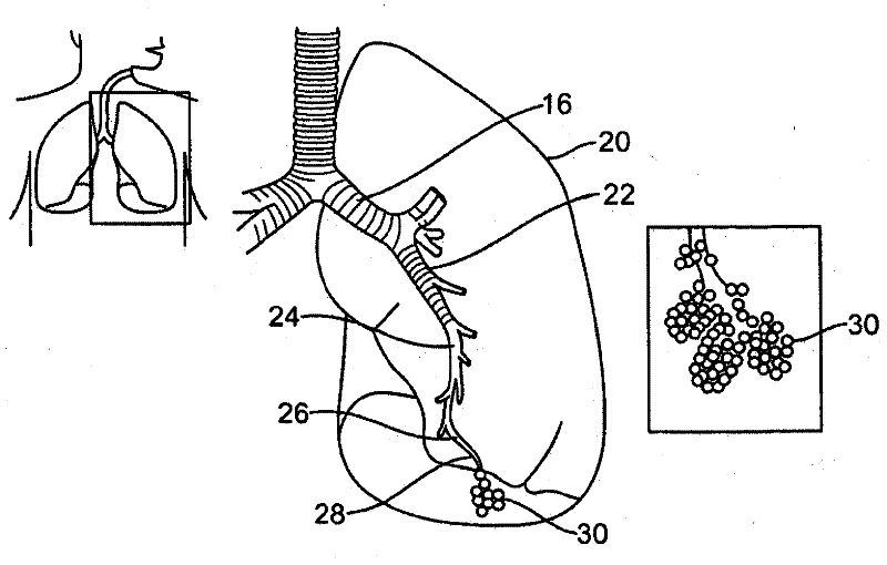 Improved and/or longer minimally invasive lung volume reduction devices and their delivery