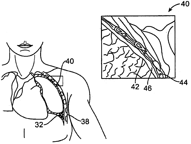 Improved and/or longer minimally invasive lung volume reduction devices and their delivery