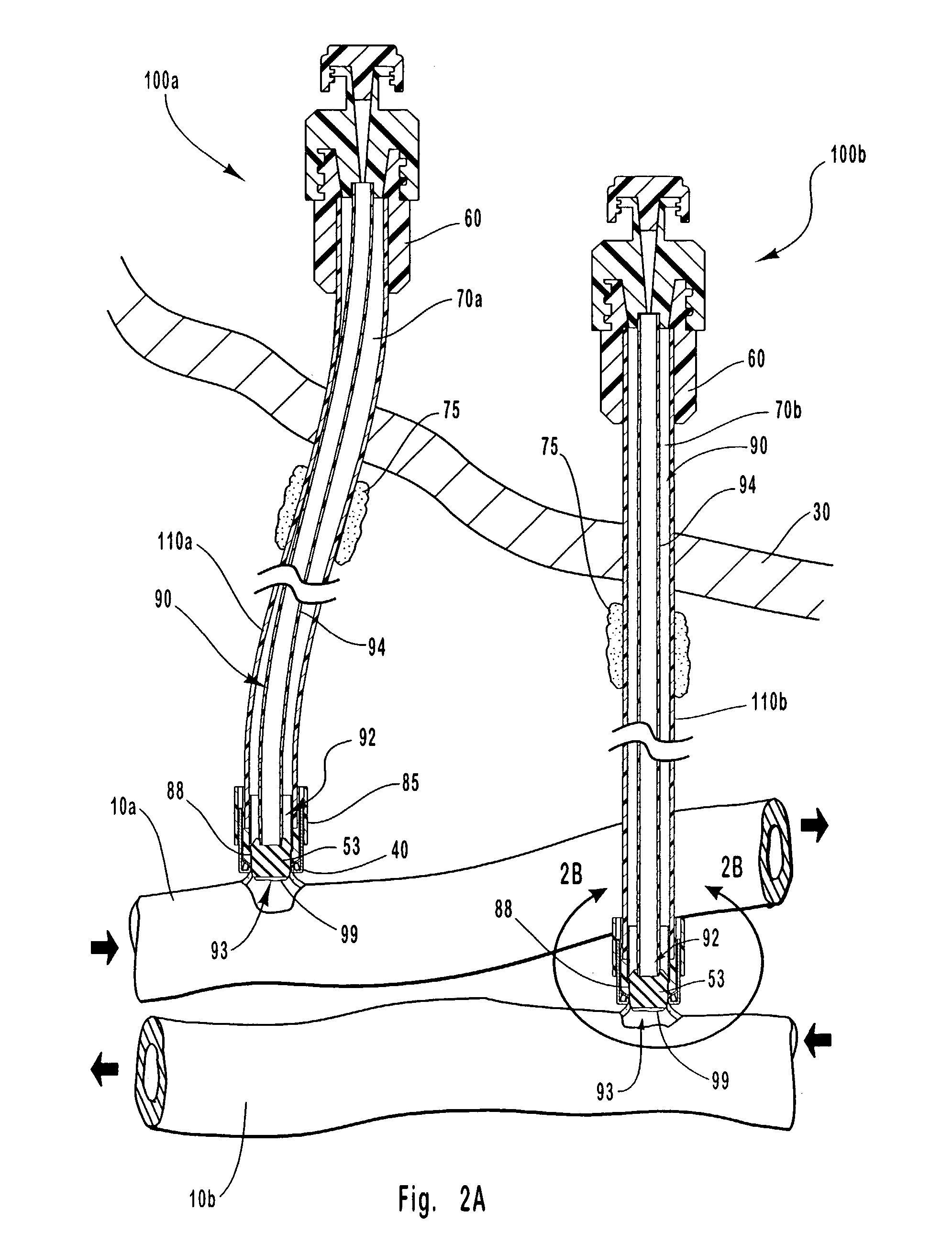 Apparatus and methods for occluding an access tube anastomosed to sidewall of an anatomical vessel