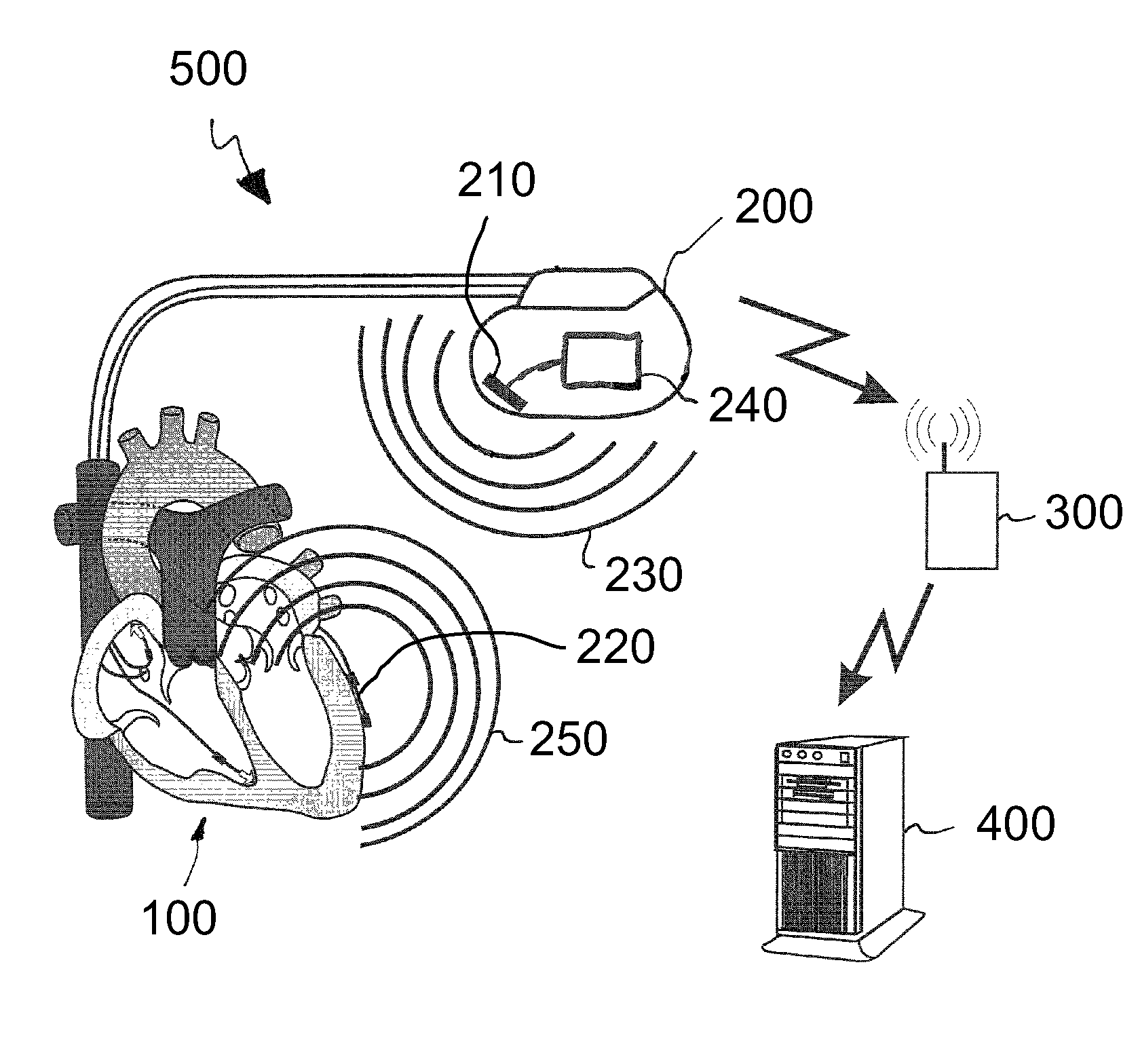 Implant and system for predicting decompensation