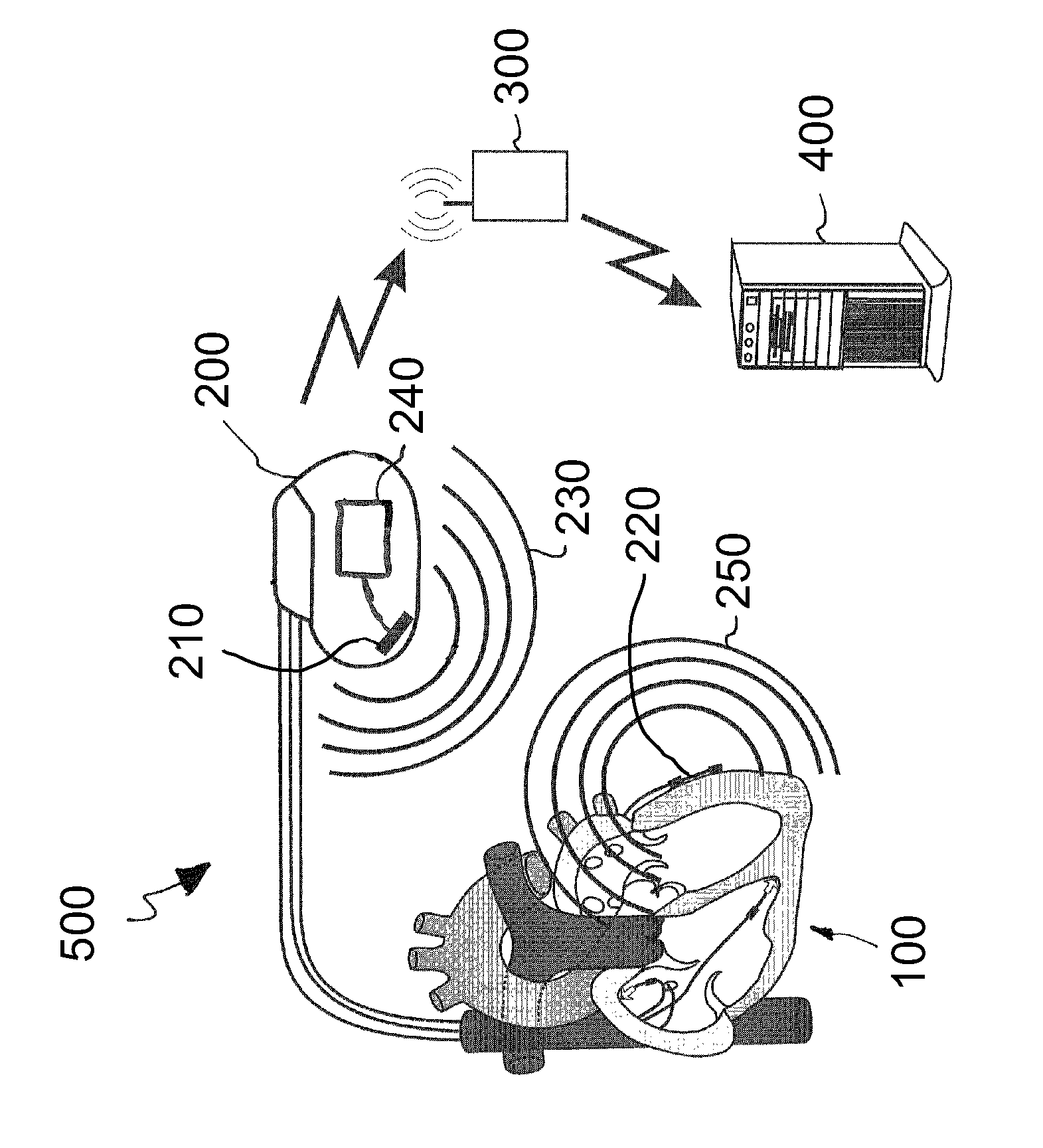 Implant and system for predicting decompensation