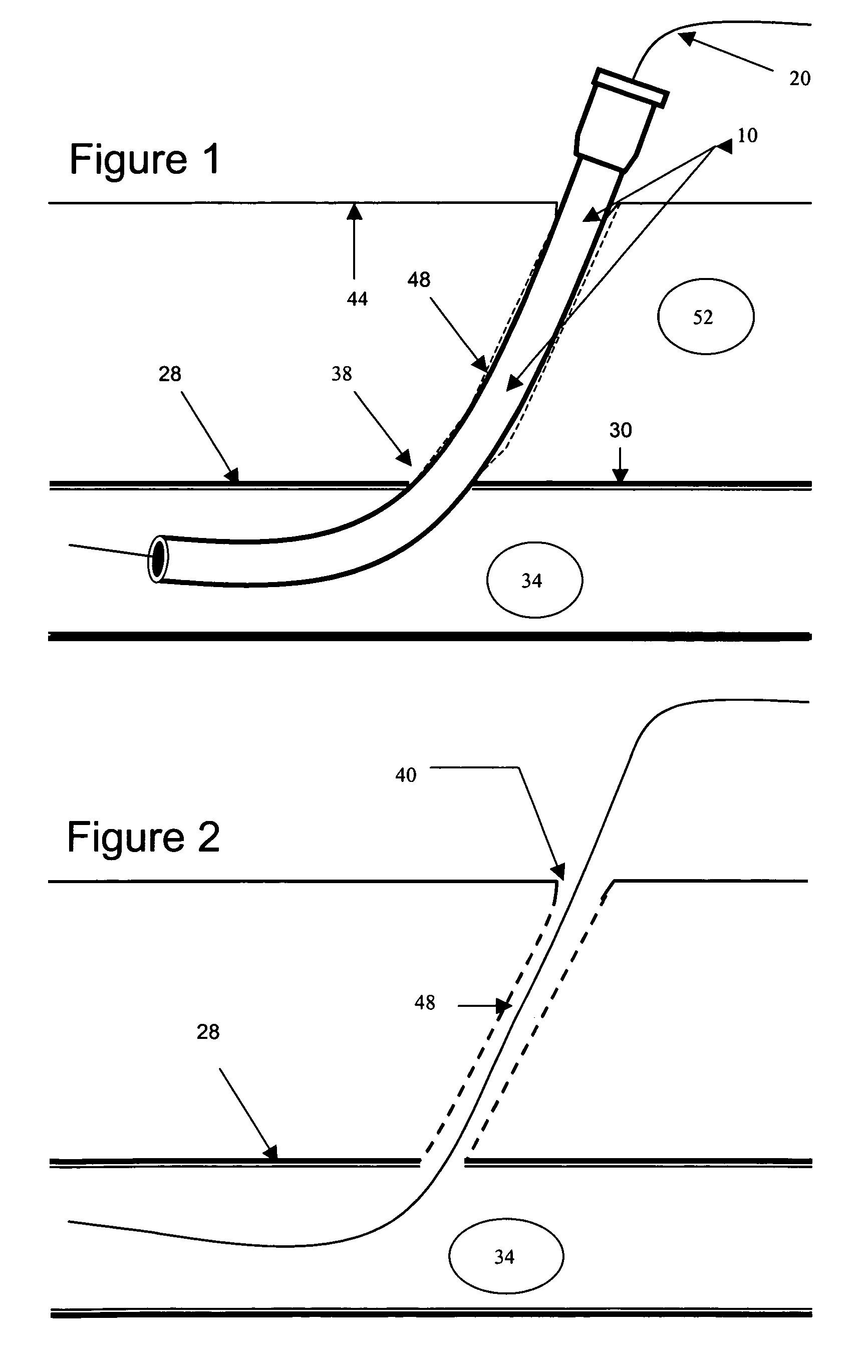 Hemostatic wire guided bandage and method of use