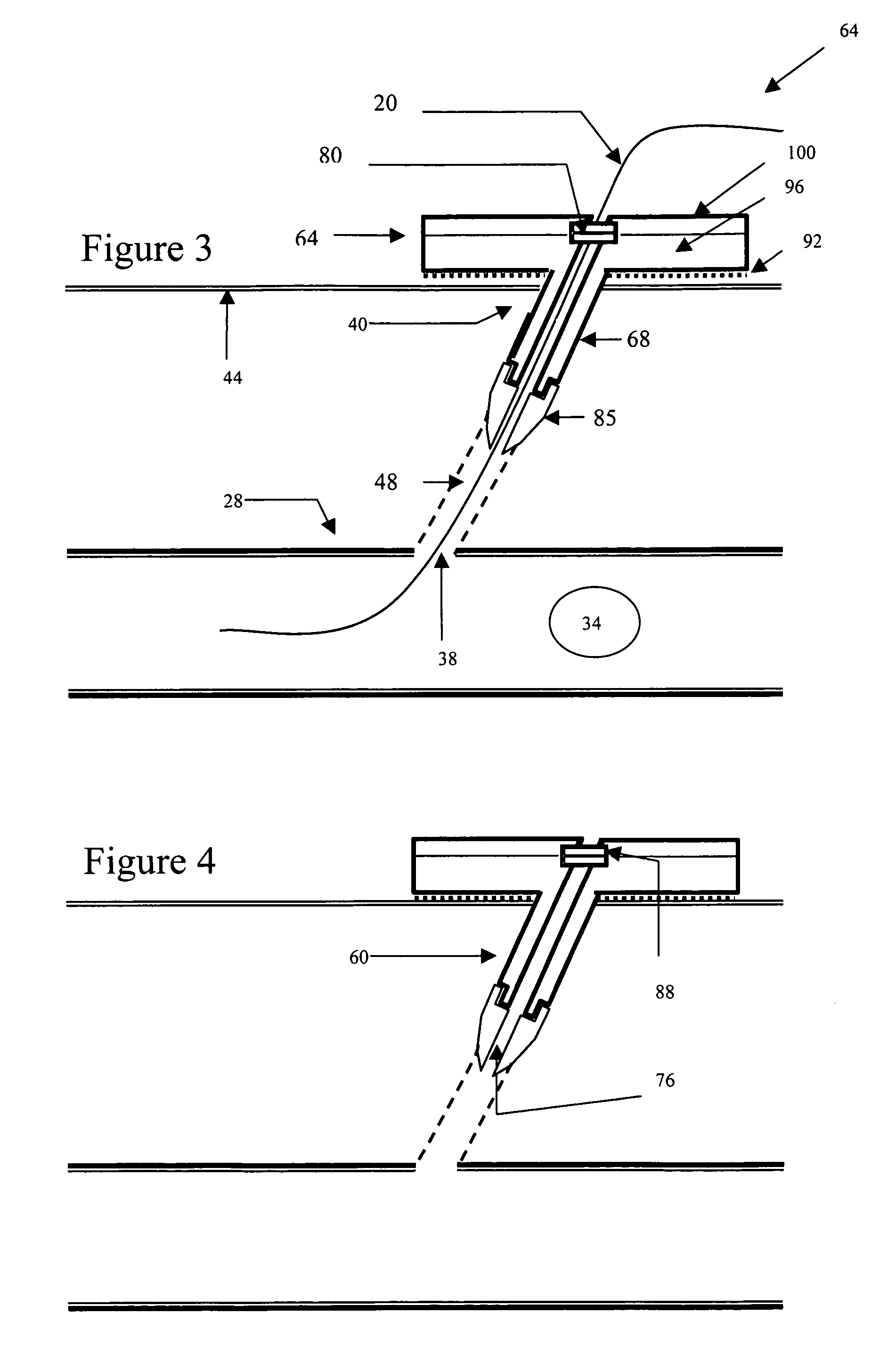 Hemostatic wire guided bandage and method of use