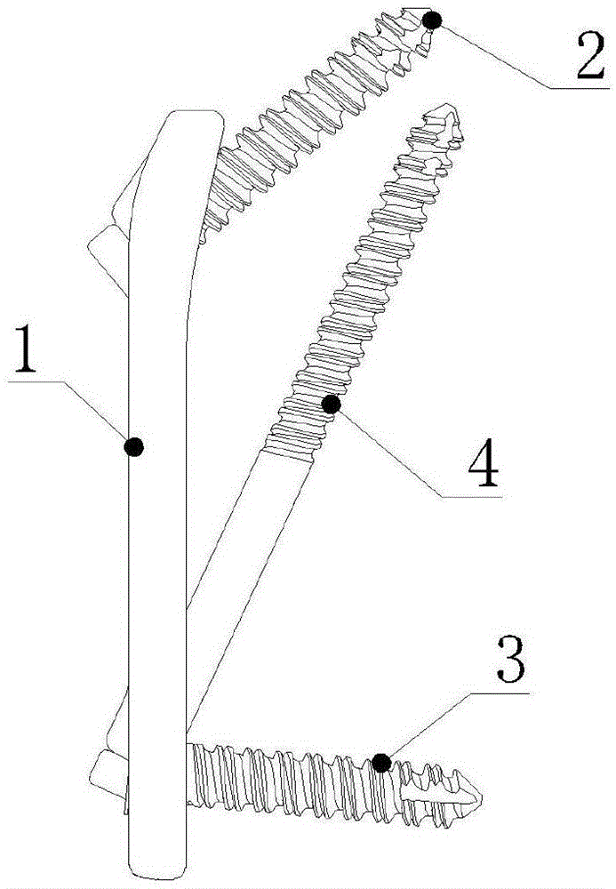 Cervical vertebra 2-3 anterior reduction steel plate system