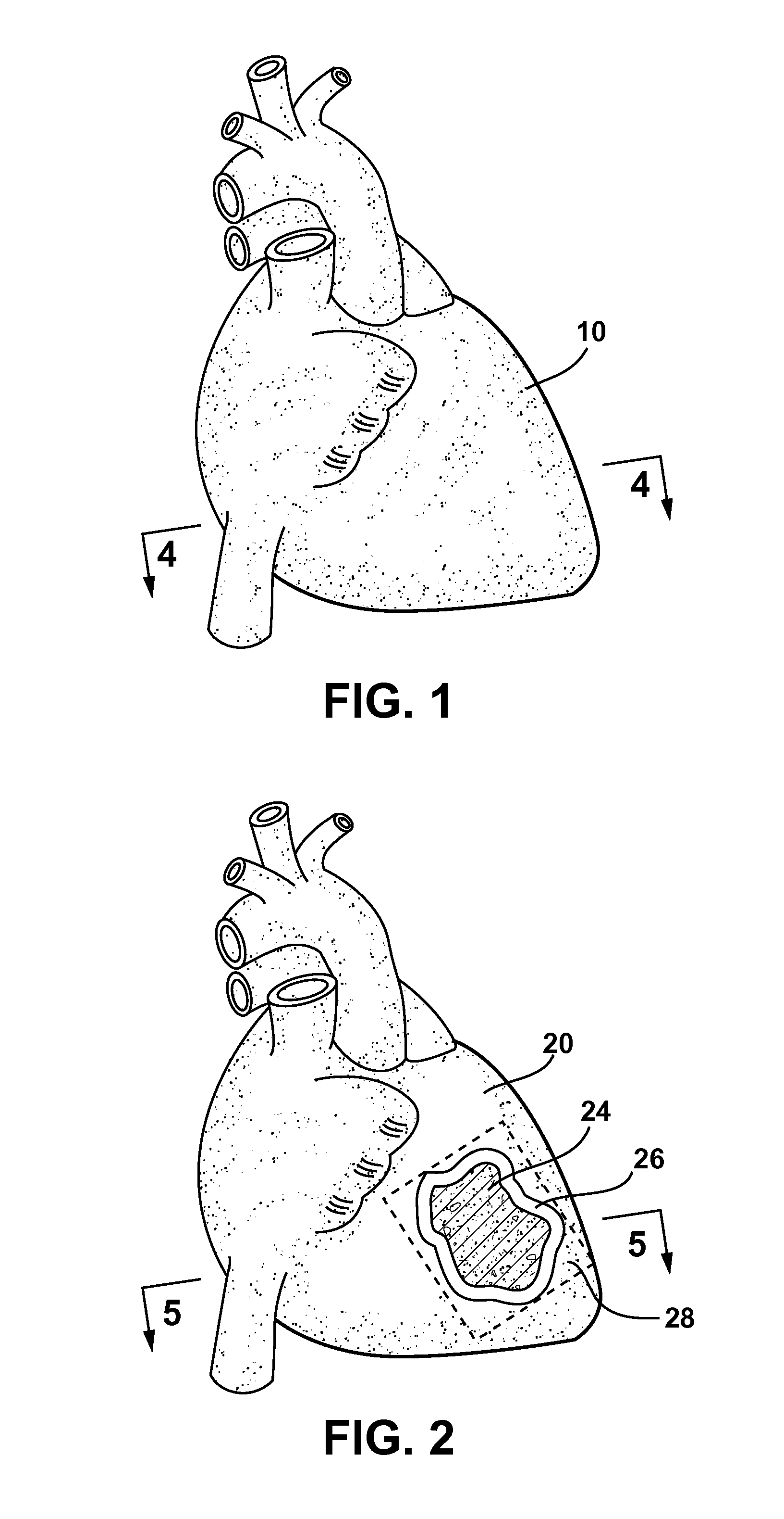 Methods and Systems for Treating Injured Cardiac Tissue
