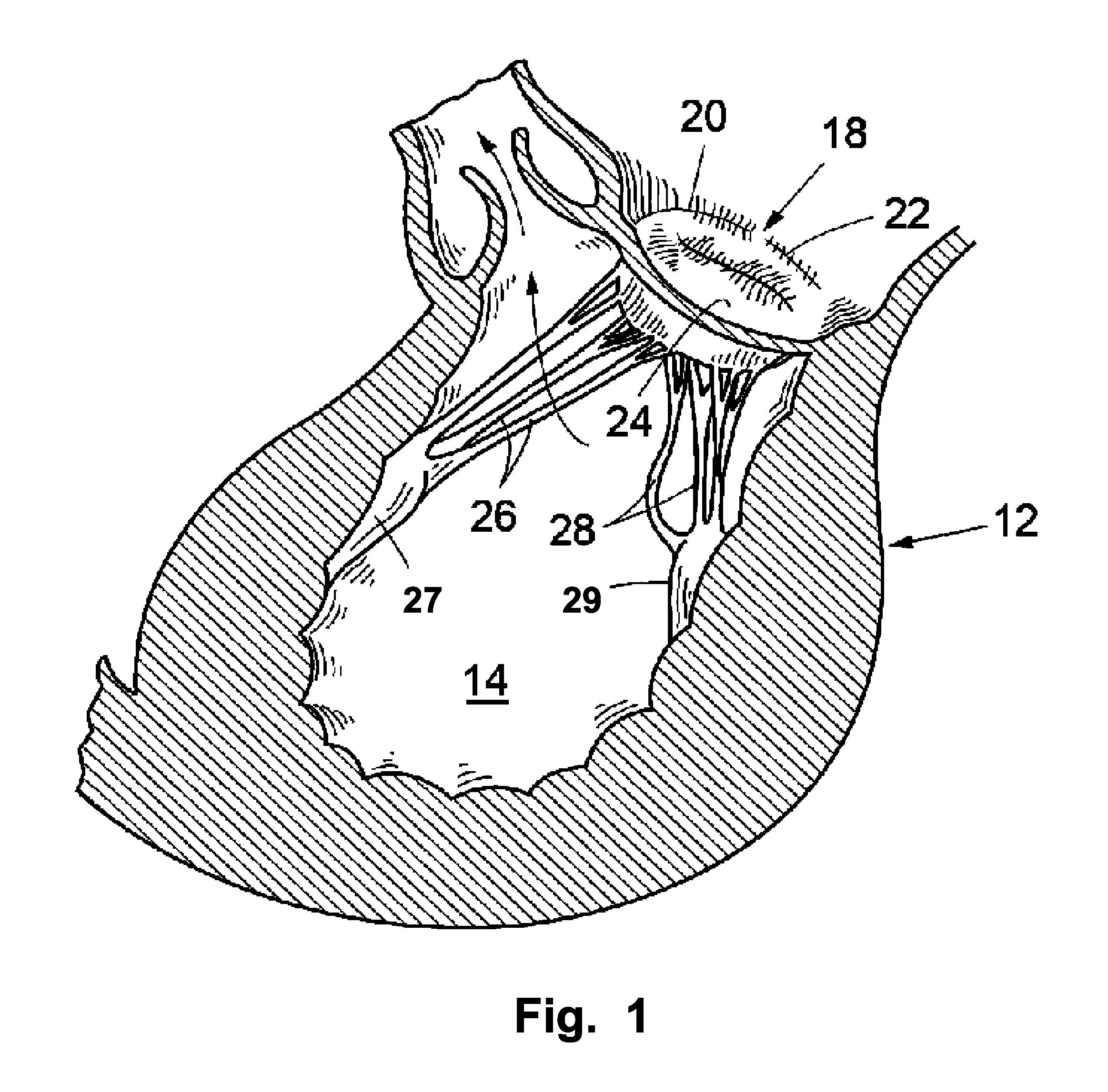 Arrangement, a loop-shaped support, a prosthetic heart valve and a method of repairing or replacing a native heart valve