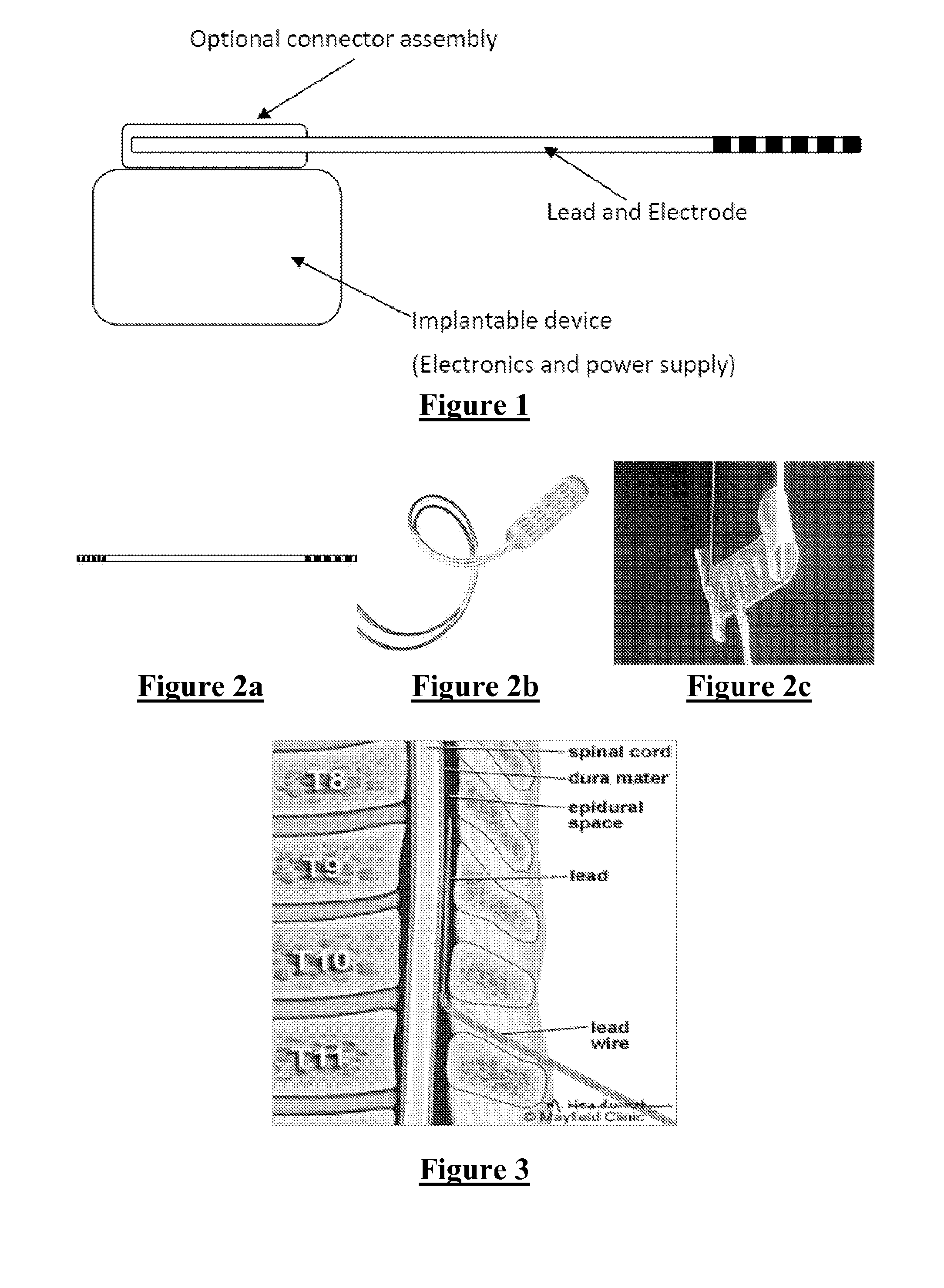 Electrode Assembly for an Active Implantable Medical Device