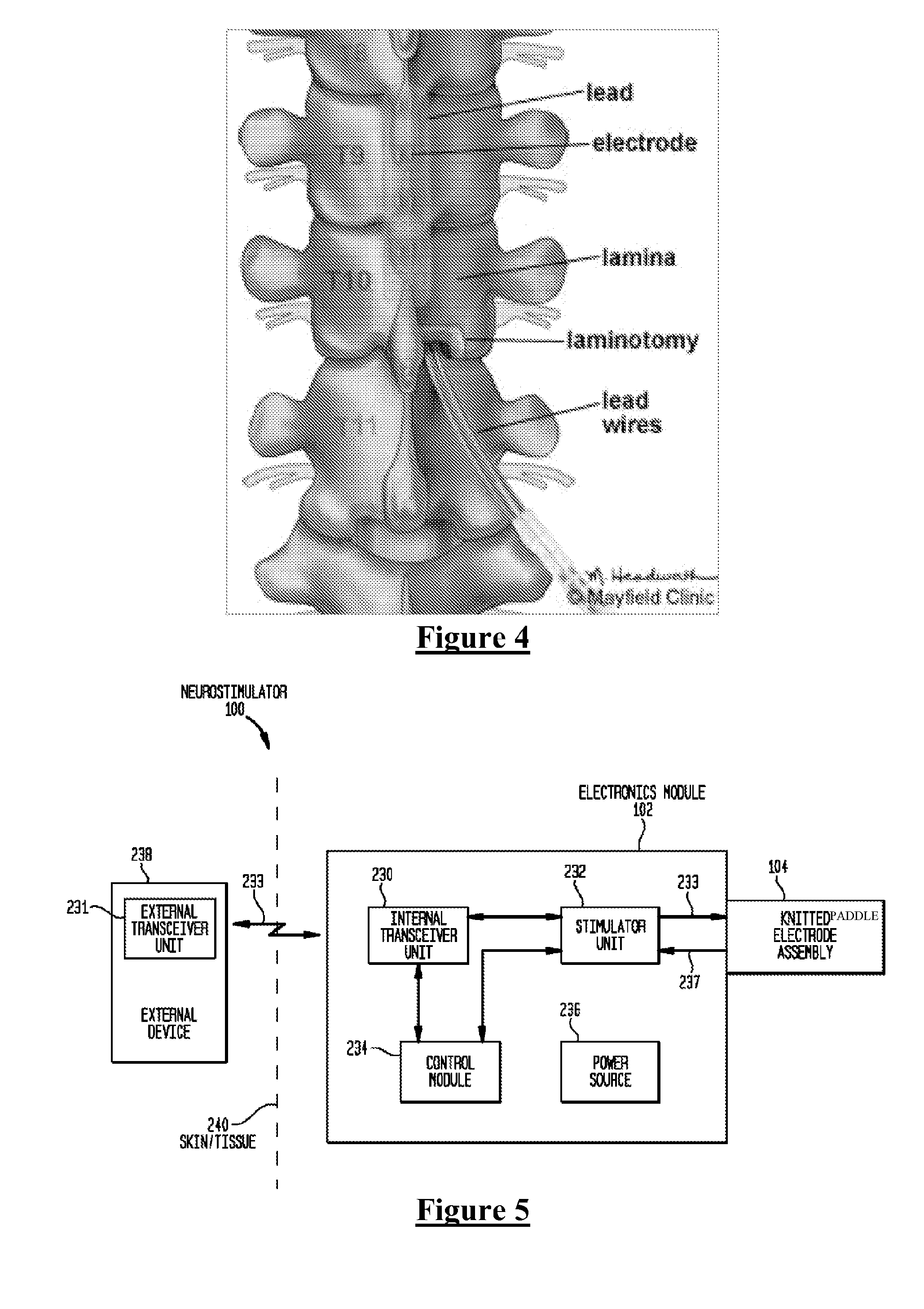 Electrode Assembly for an Active Implantable Medical Device