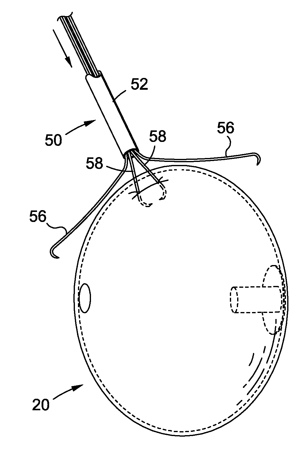 Endoscopic Tools for the Removal of Balloon-Like Intragastric Devices