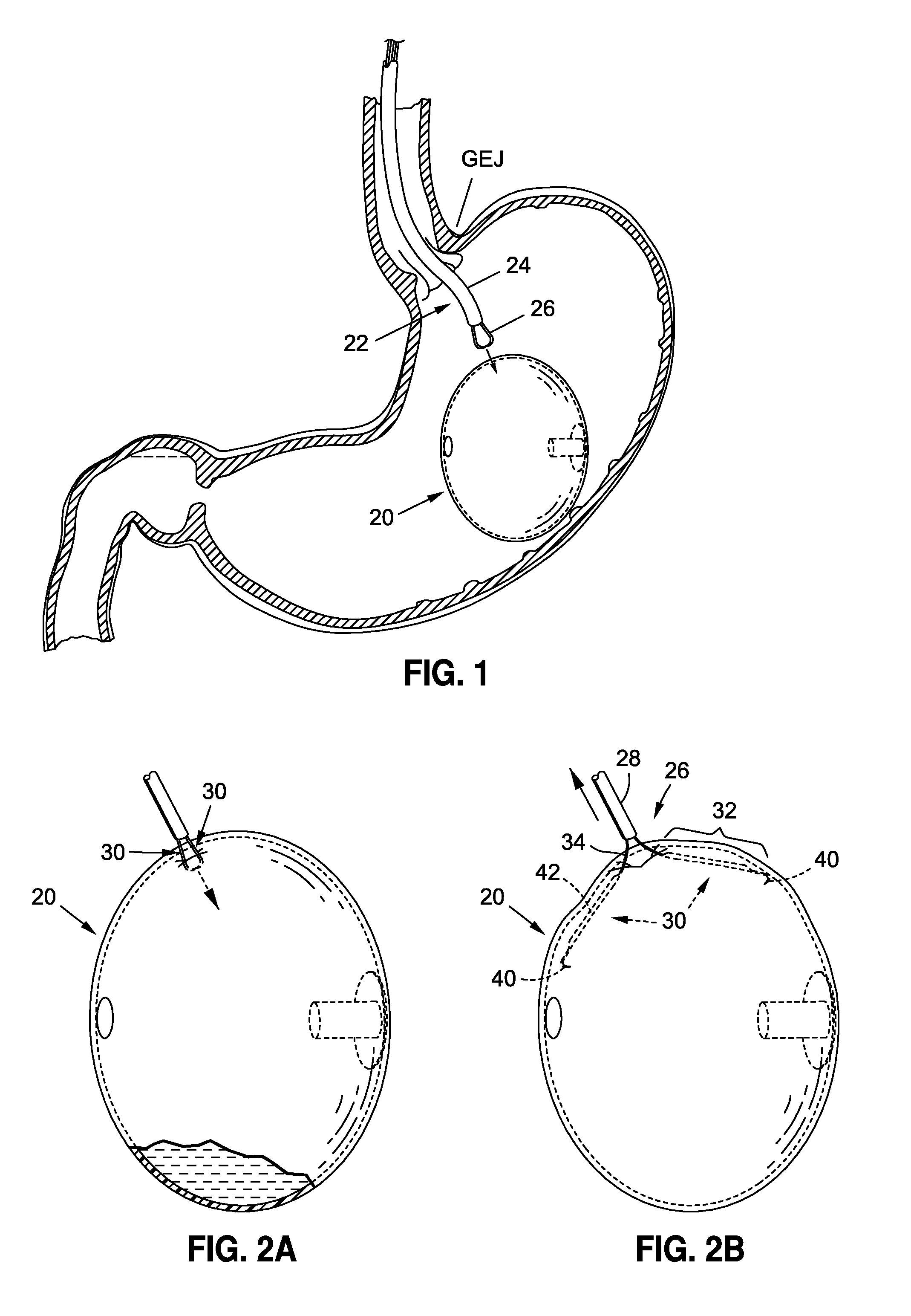 Endoscopic Tools for the Removal of Balloon-Like Intragastric Devices