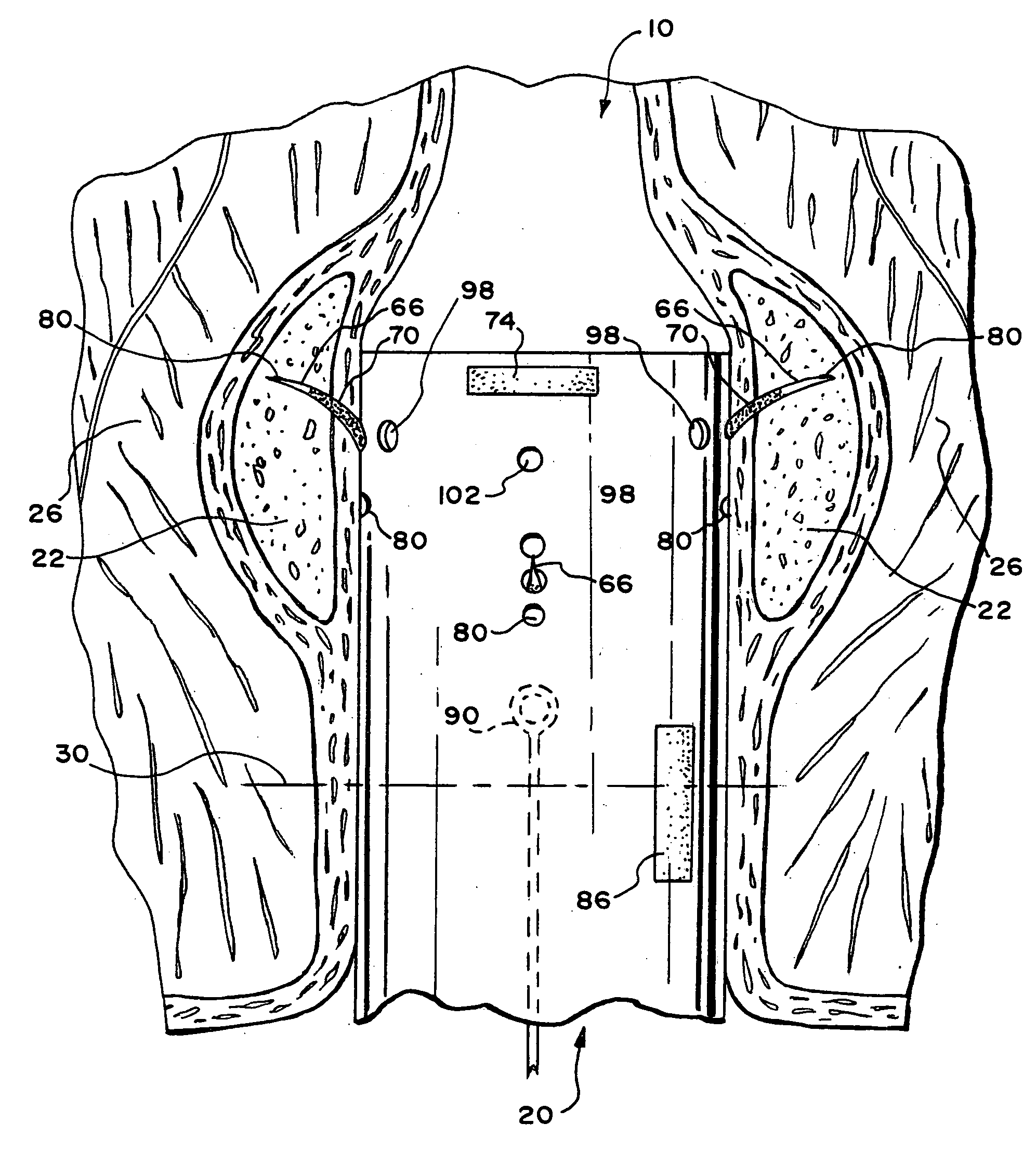 Method for treating fecal incontinence