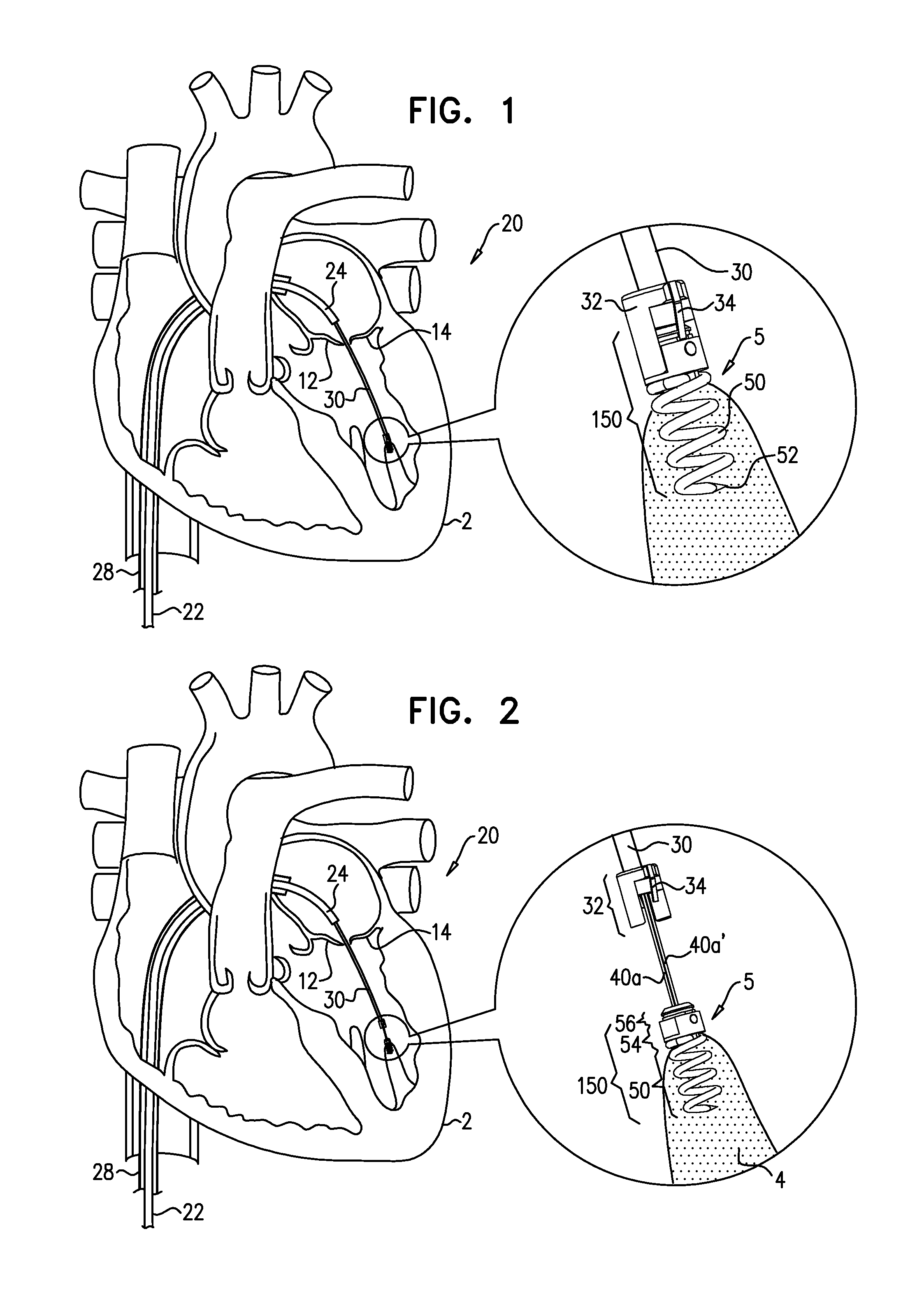 Apparatus for guide-wire based advancement of a rotation assembly