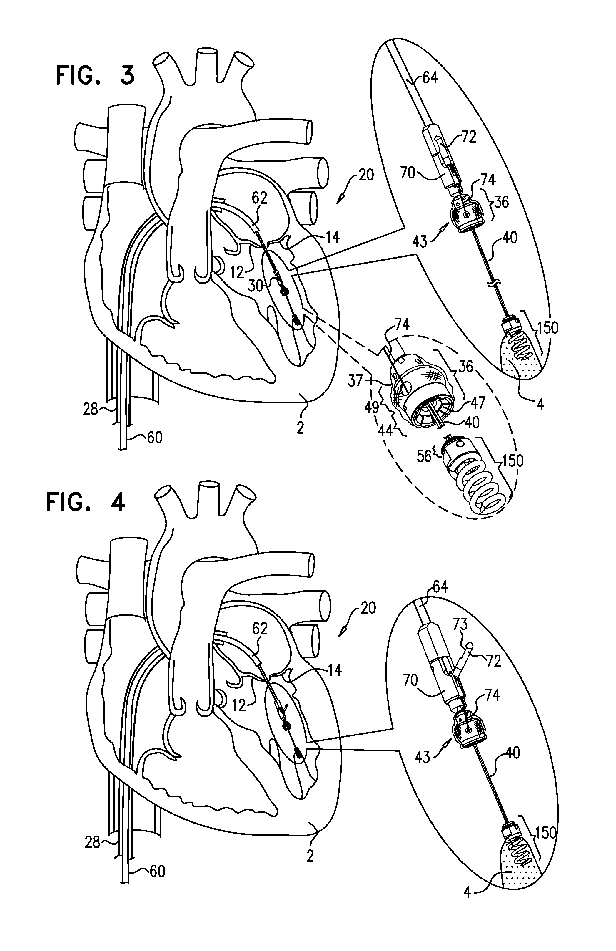 Apparatus for guide-wire based advancement of a rotation assembly