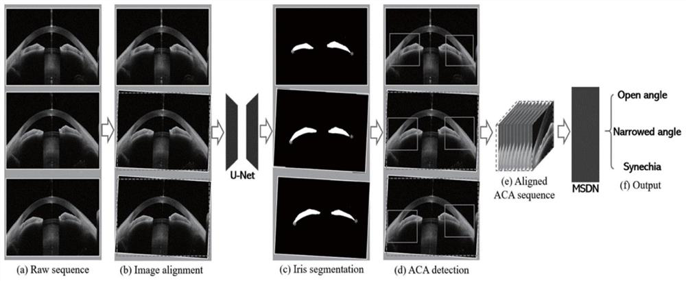AS-OCT image room angle classification method based on convolutional recurrent neural network