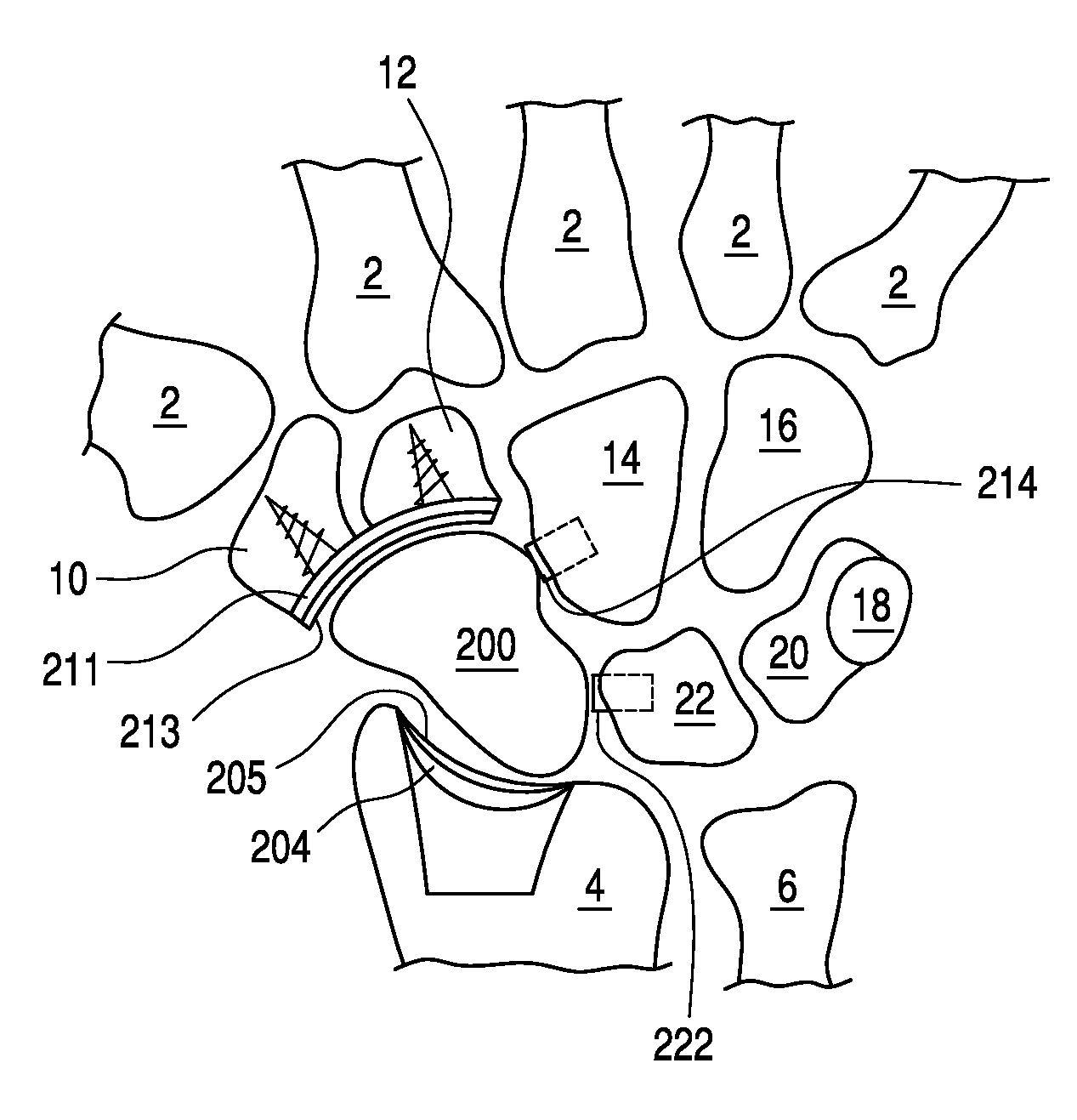 Bone prosthesis for maintaining joint operation in complex joints