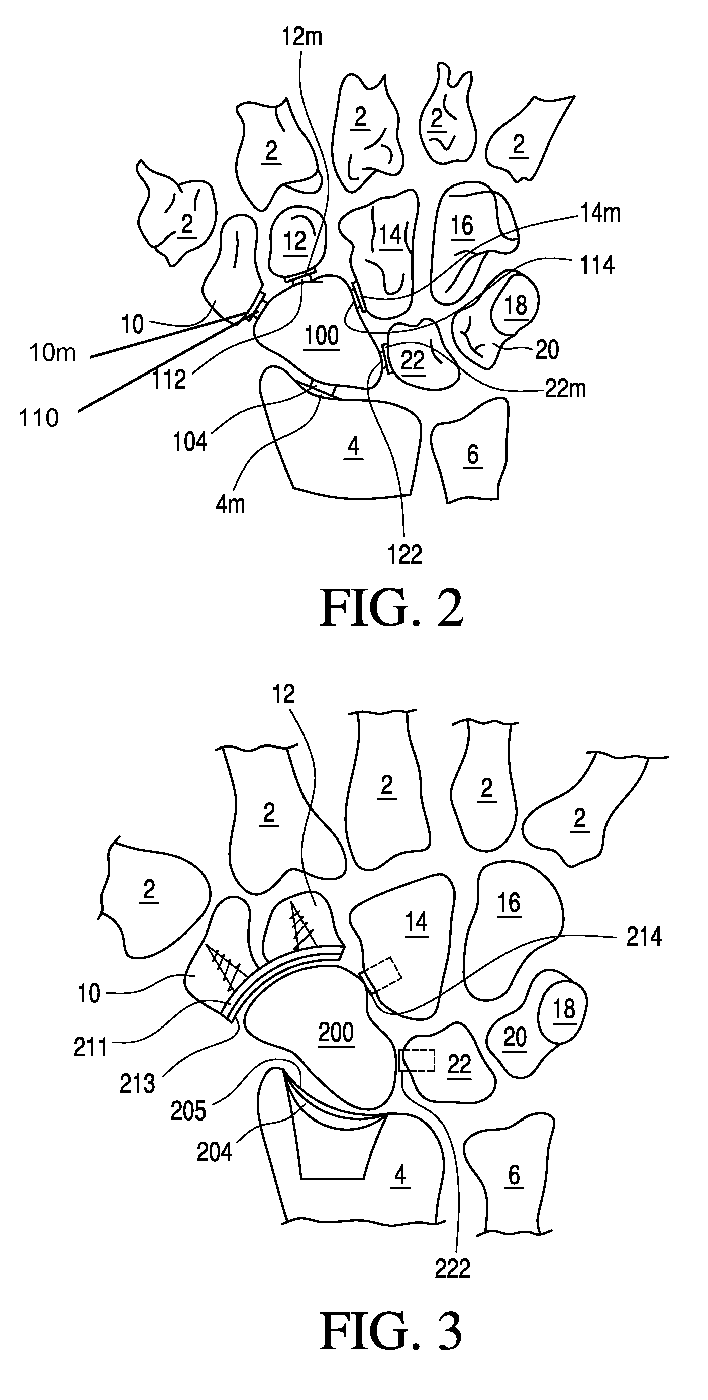 Bone prosthesis for maintaining joint operation in complex joints