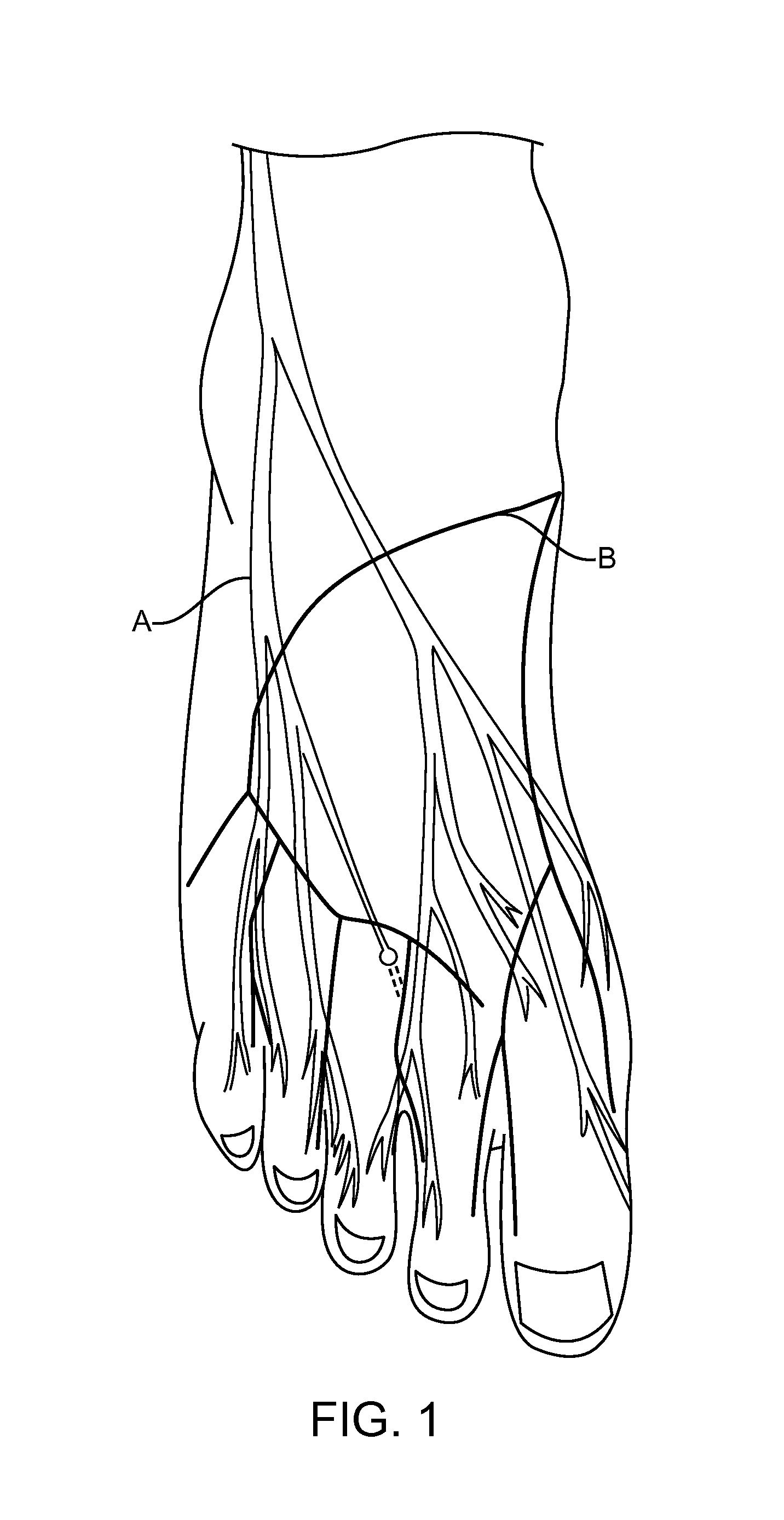Methods and Compositions for Treating Foot or Hand Pain