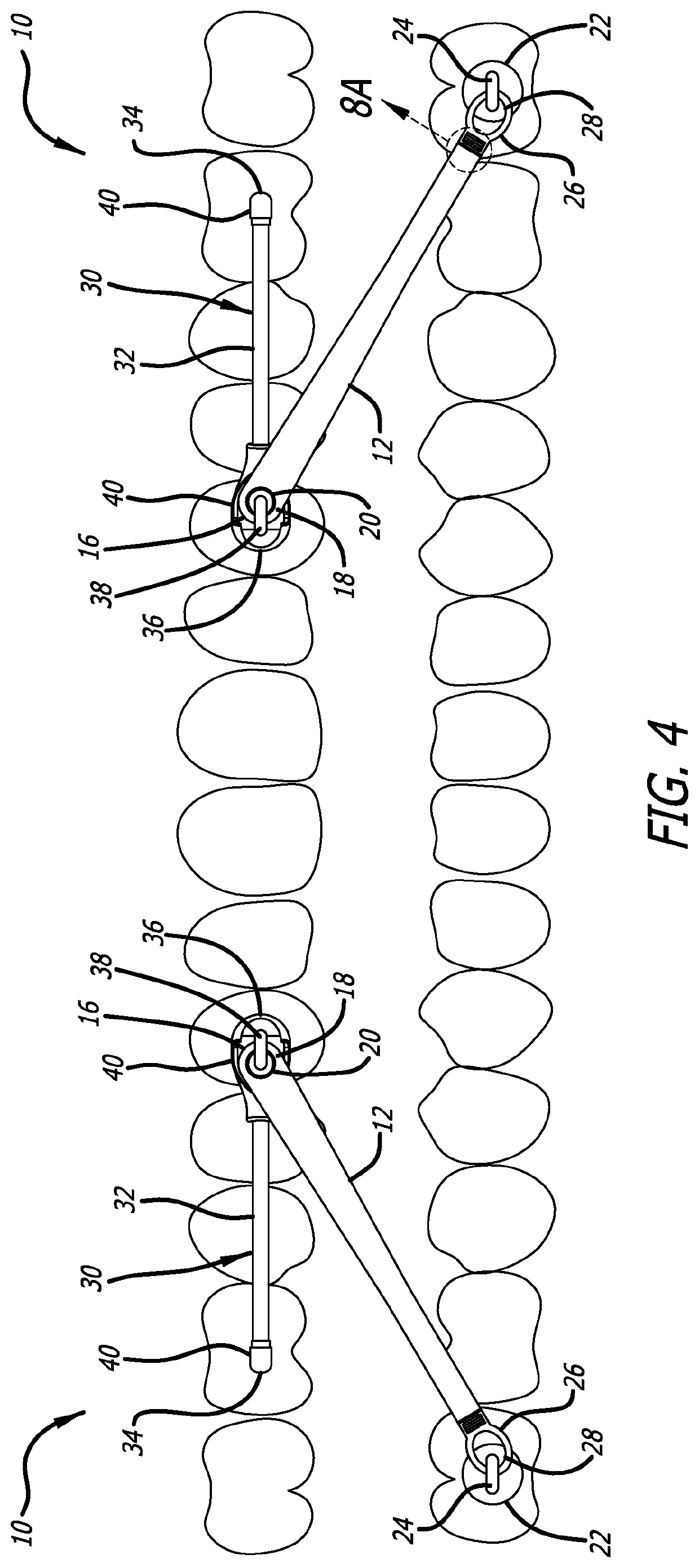 Orthodontic appliance and method of use