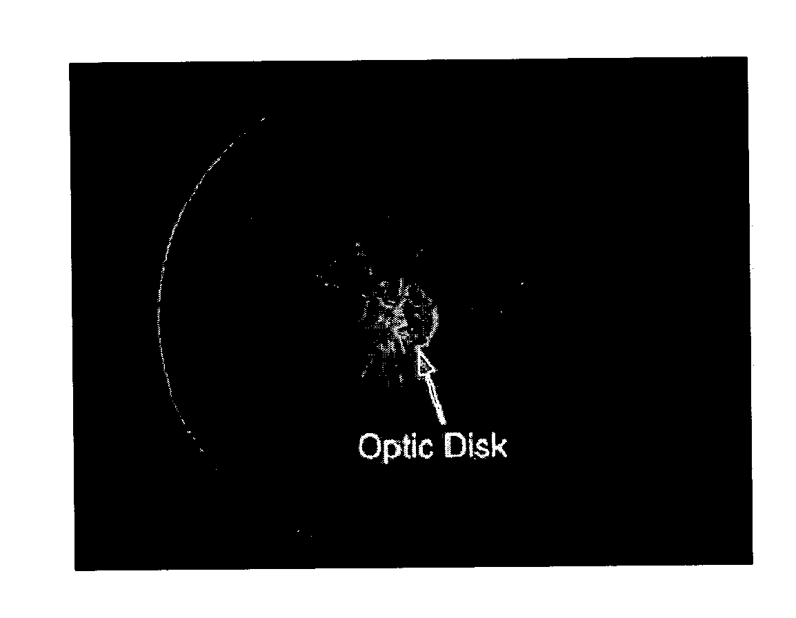 System and Method For Robust Optic Disk Detection In Retinal Images Using Vessel Structure And Radon Transform