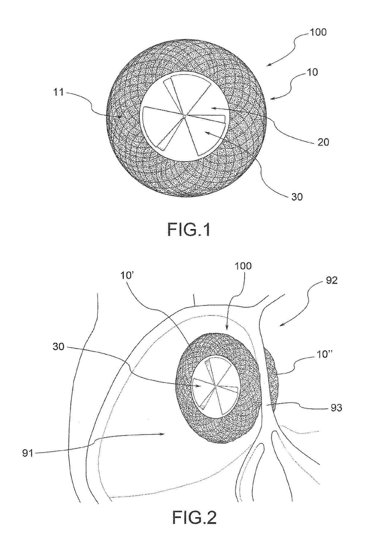 Endoluminal devices and systems for creating two-way blood flow for the treatment of heart failure