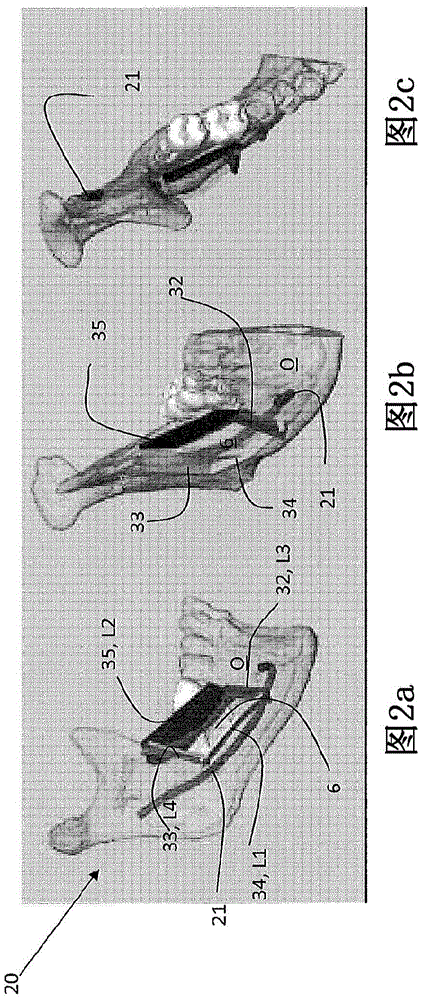 Method for making a surgical guide for bone harvesting