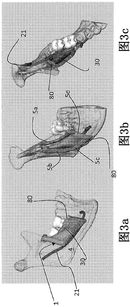 Method for making a surgical guide for bone harvesting